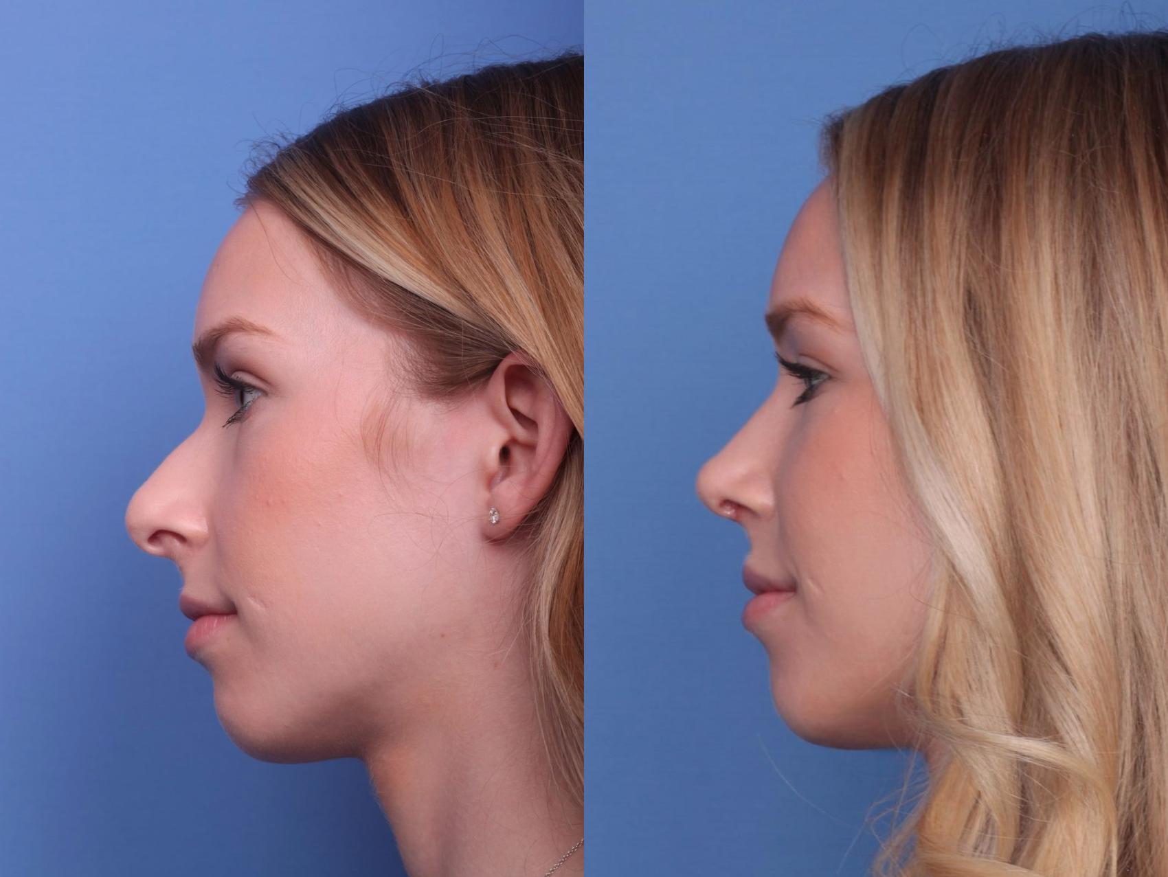 Before & After Rhinoplasty Case 25 View #2 View in Scottsdale, AZ