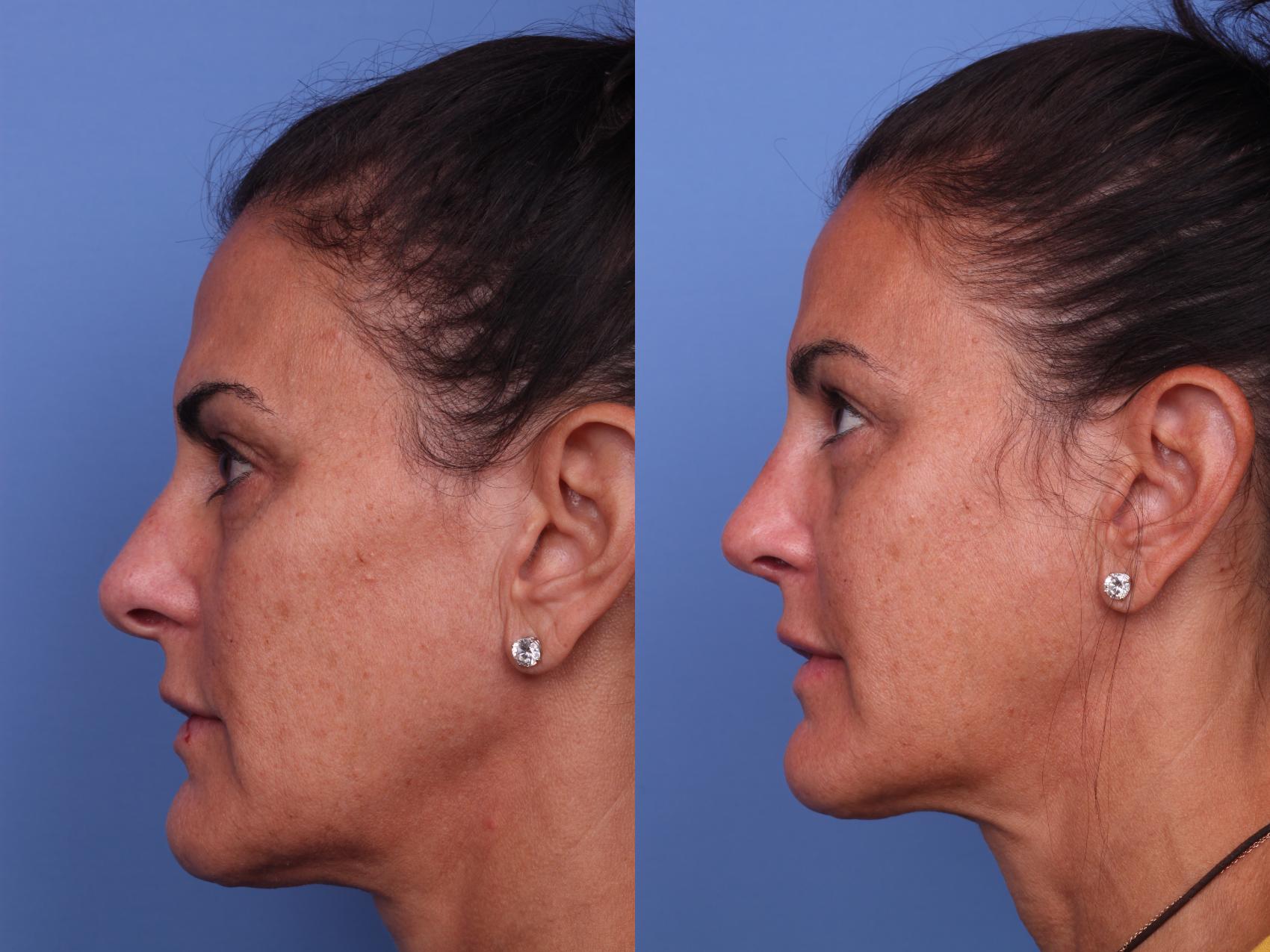 Before & After Rhinoplasty Case 251 View #2 View in Scottsdale, AZ