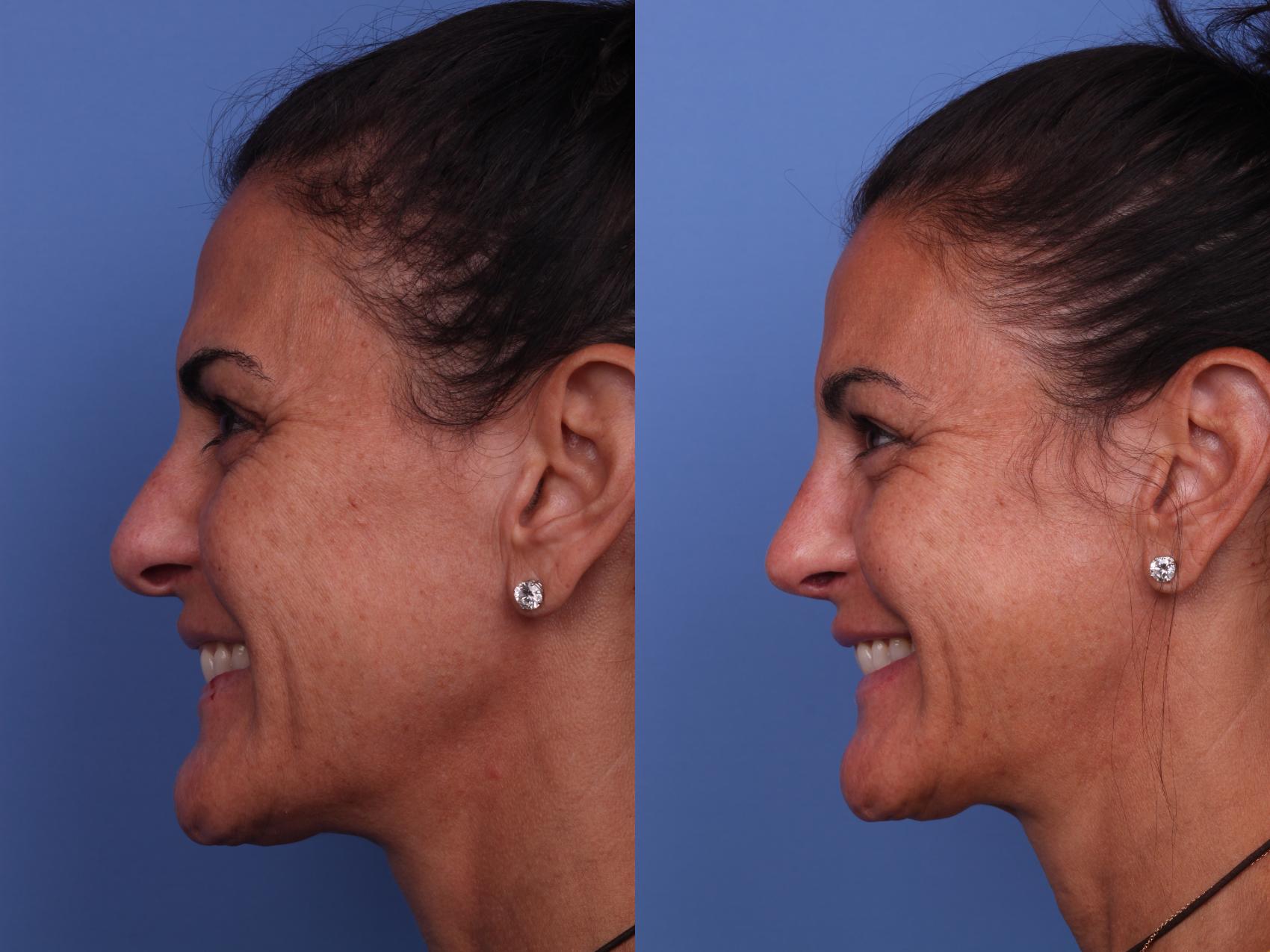 Before & After Rhinoplasty Case 251 View #3 View in Scottsdale, AZ