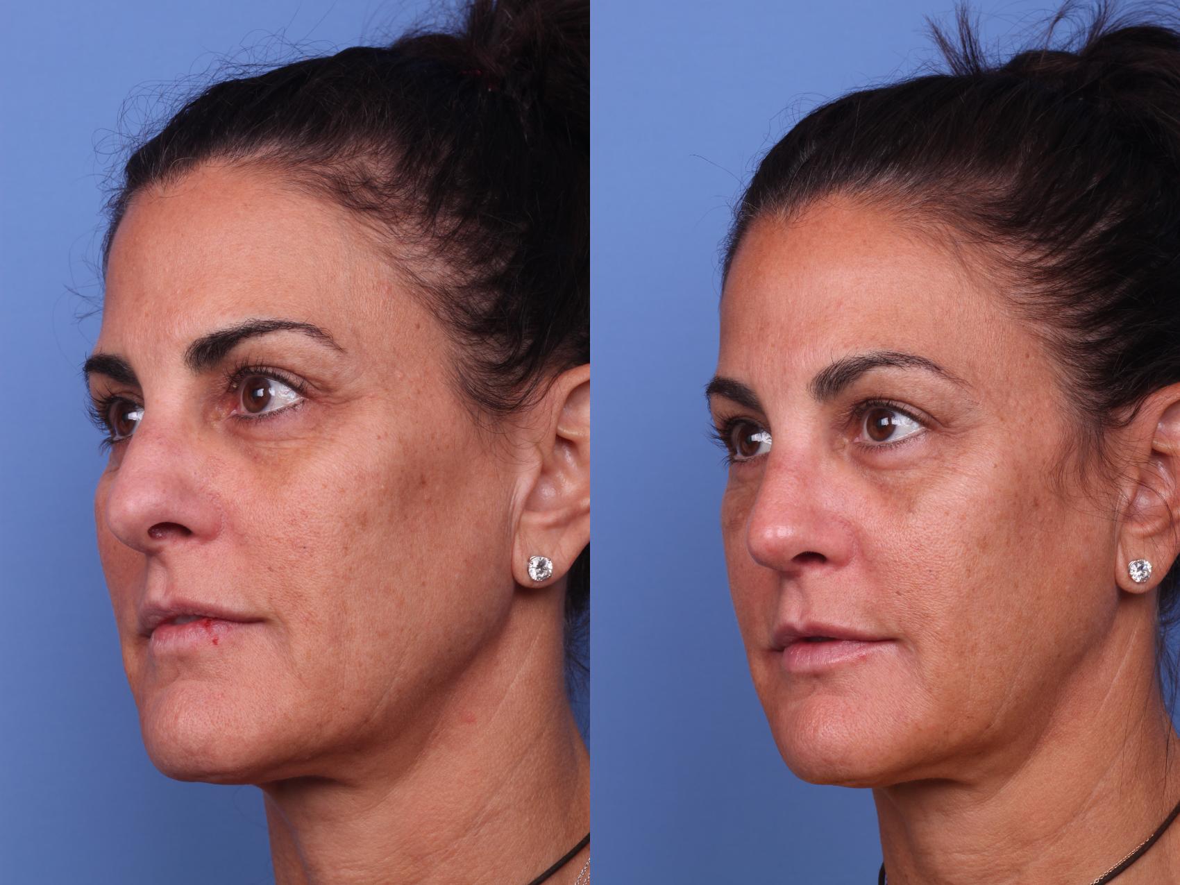 Before & After Rhinoplasty Case 251 View #4 View in Scottsdale, AZ