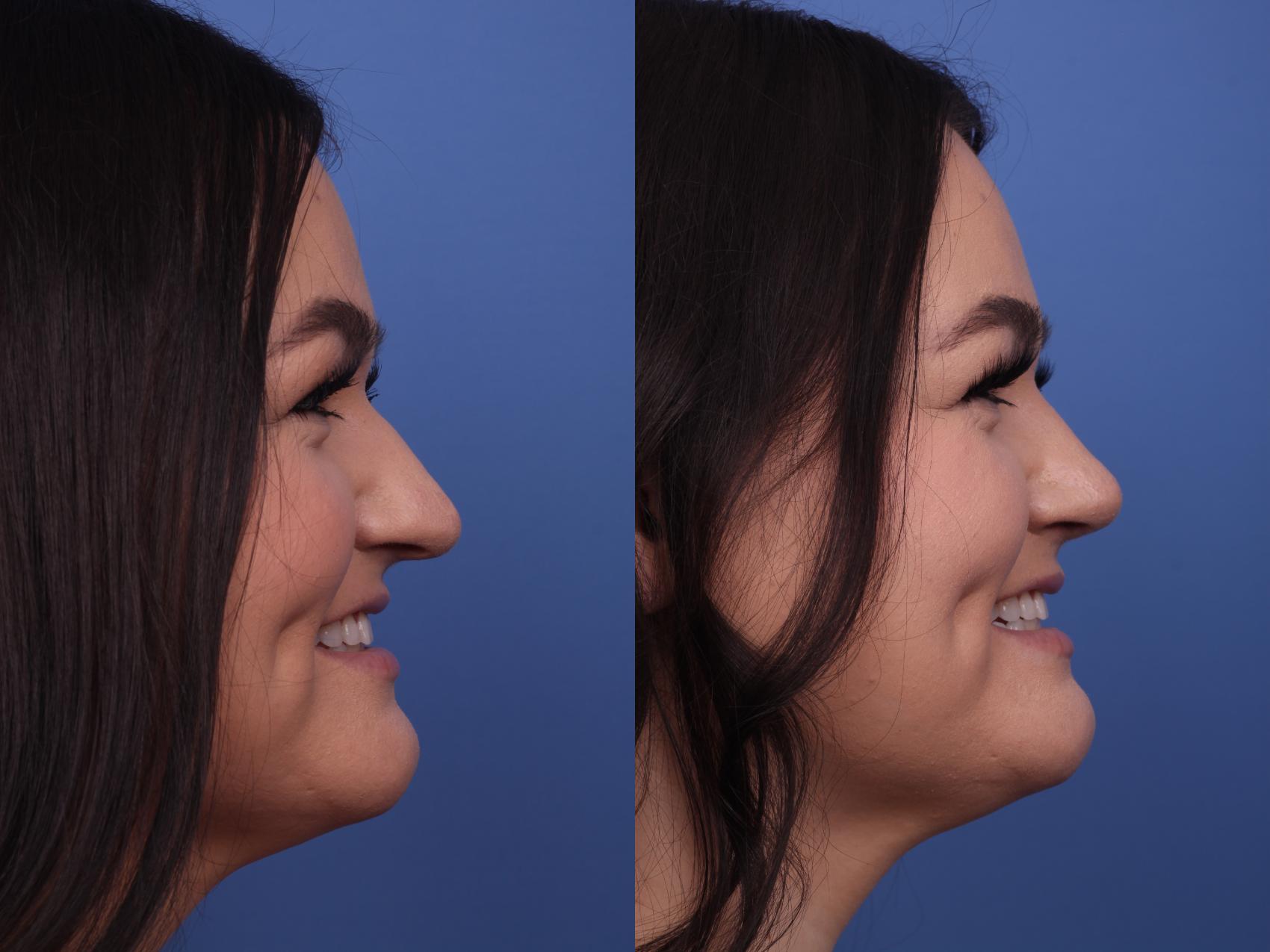 Before & After Rhinoplasty Case 253 View #2 View in Scottsdale, AZ