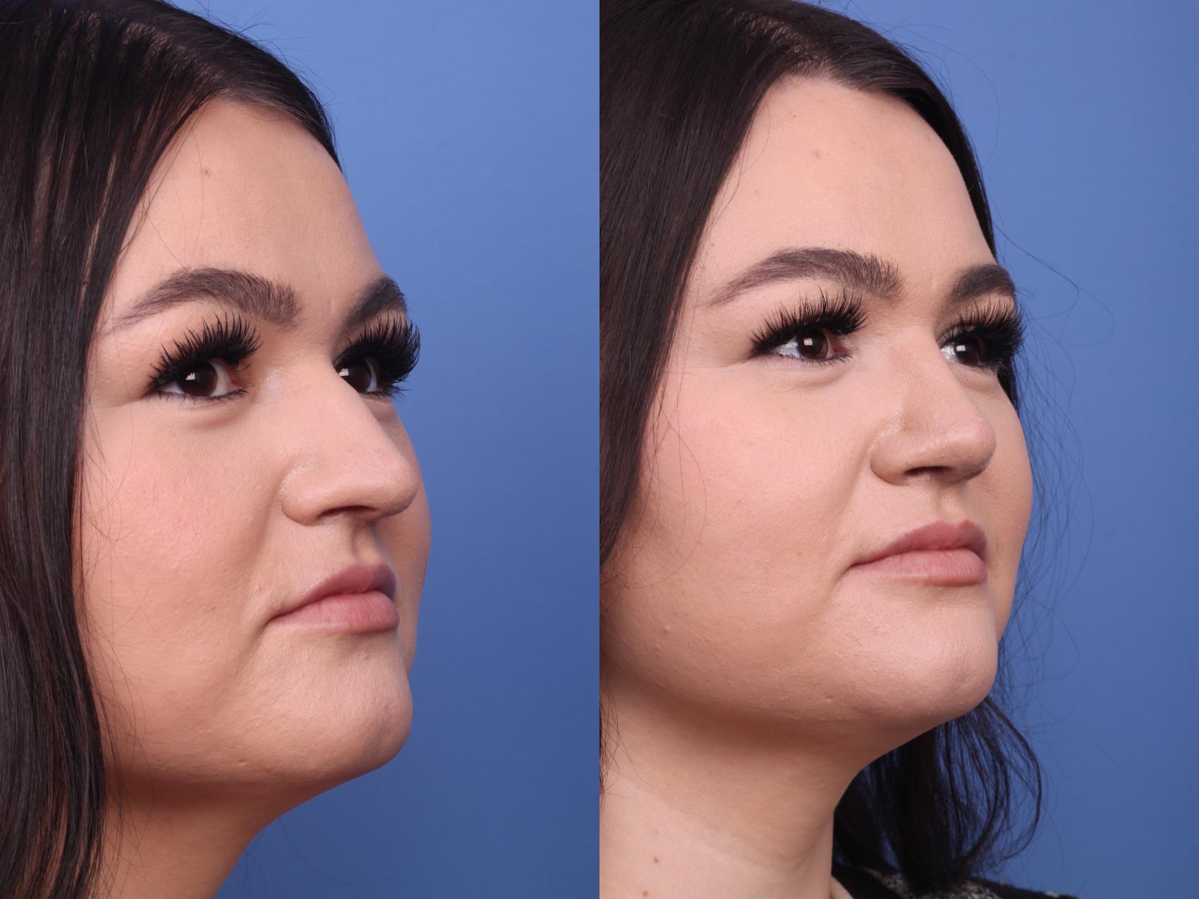 Before & After Rhinoplasty Case 253 View #3 View in Scottsdale, AZ