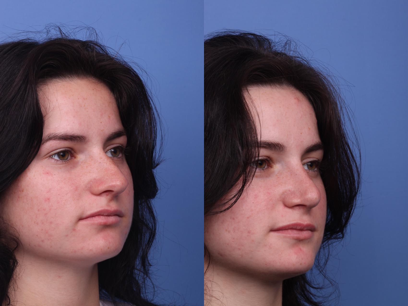 Before & After Rhinoplasty Case 254 View #2 View in Scottsdale, AZ