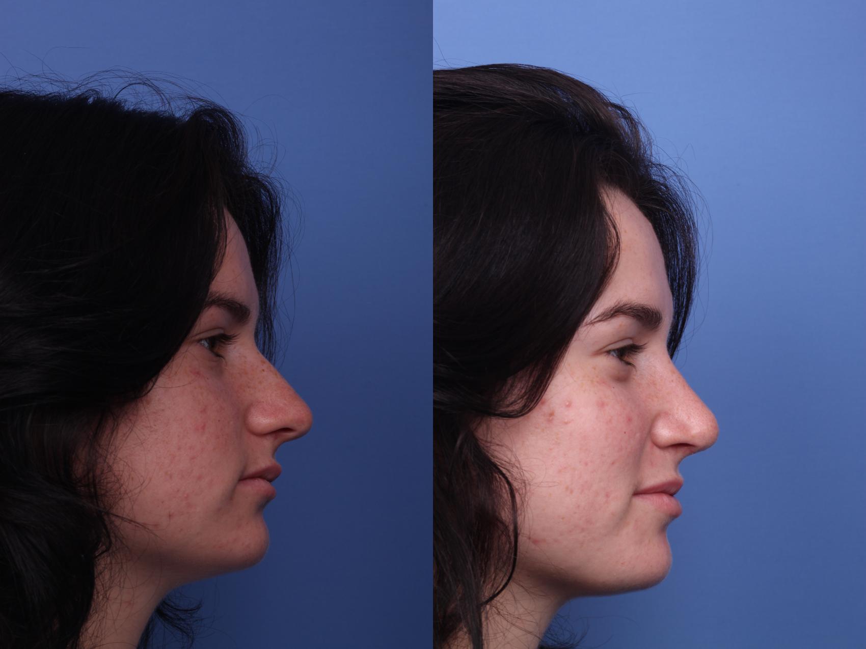 Before & After Rhinoplasty Case 254 View #3 View in Scottsdale, AZ