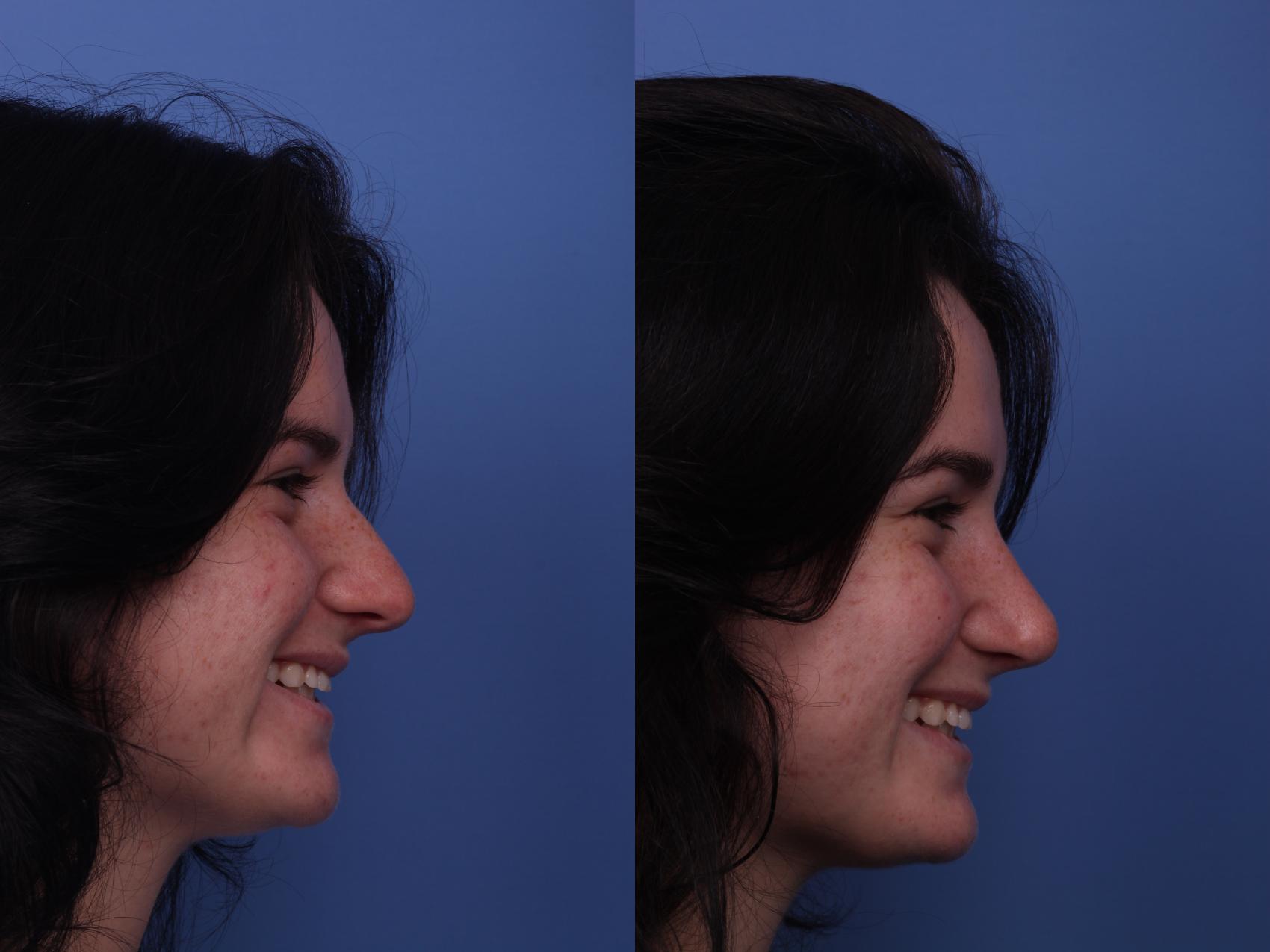 Before & After Rhinoplasty Case 254 View #4 View in Scottsdale, AZ