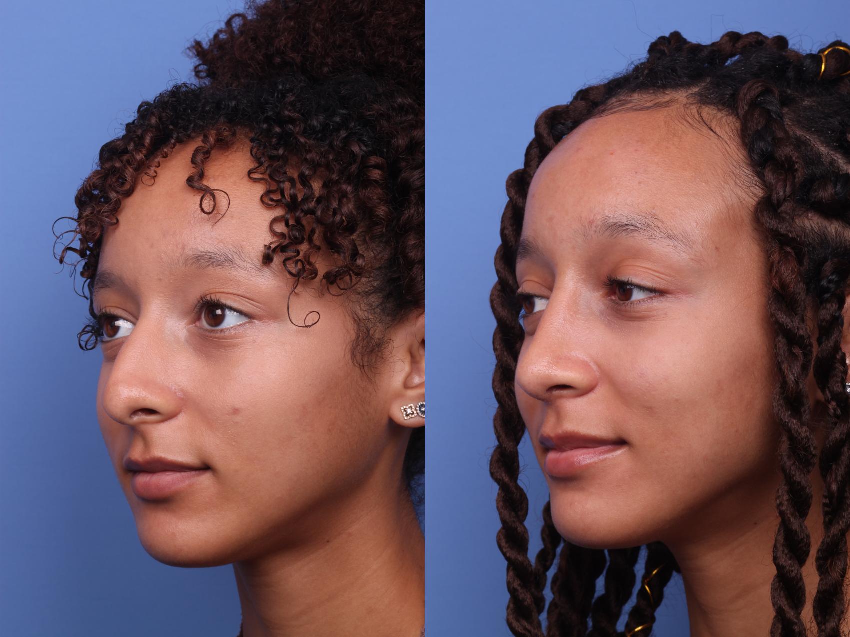 Before & After Rhinoplasty Case 255 View #2 View in Scottsdale, AZ