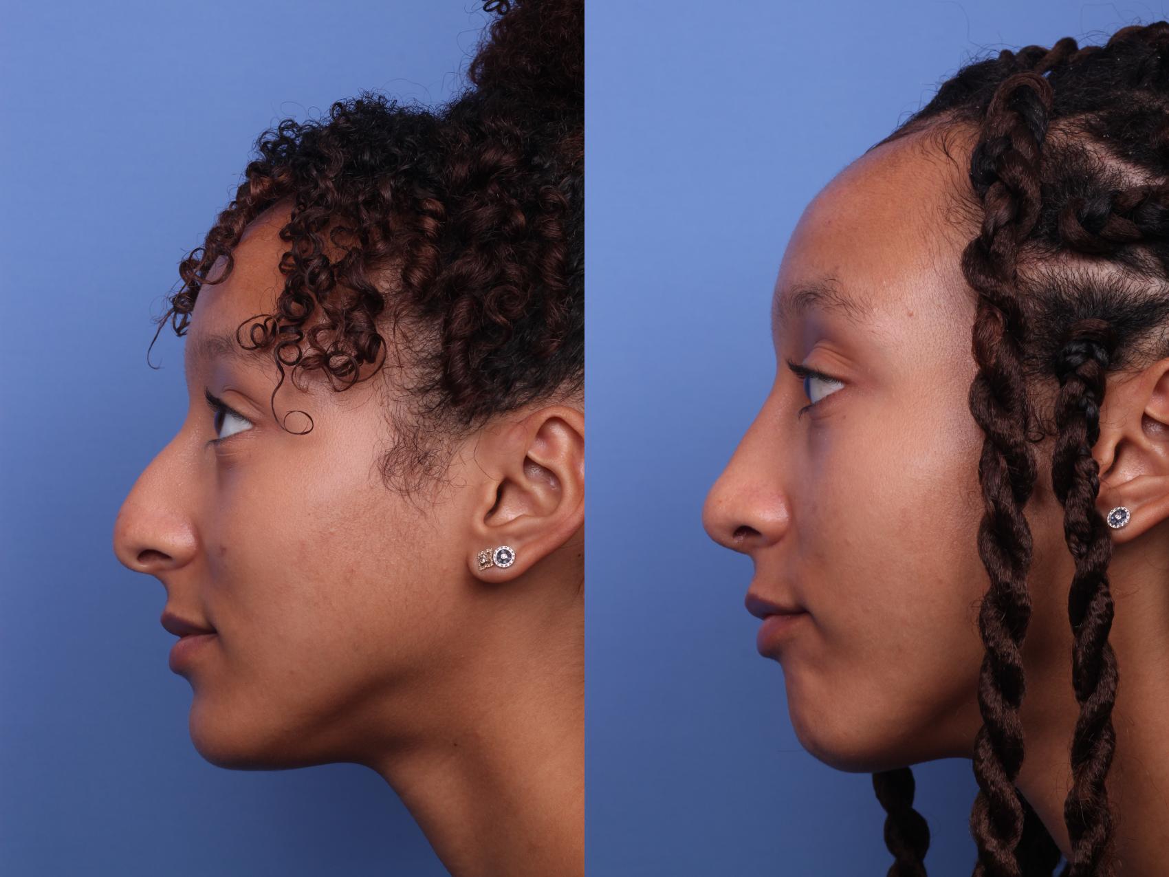 Before & After Rhinoplasty Case 255 View #3 View in Scottsdale, AZ