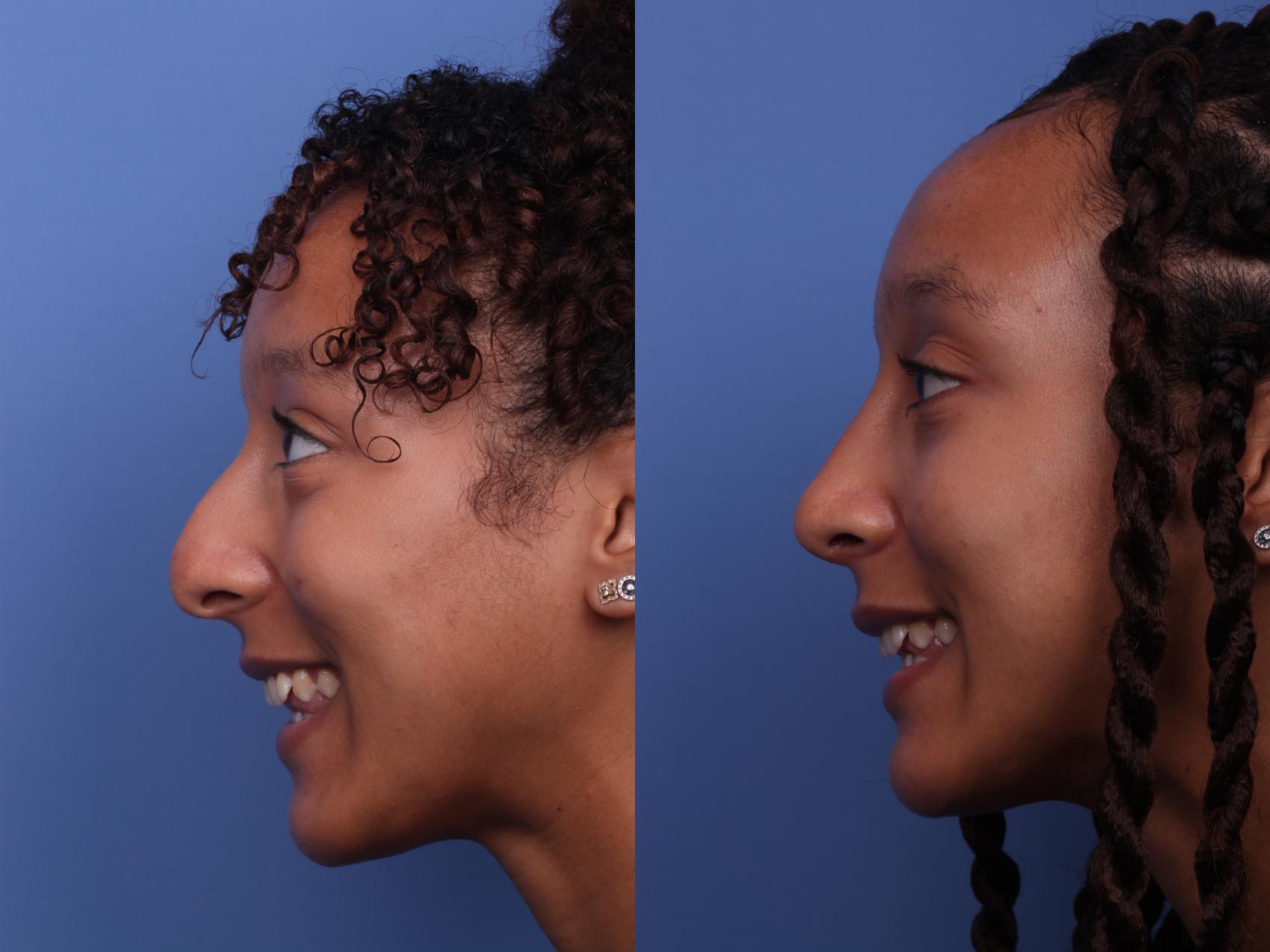 Before & After Rhinoplasty Case 255 View #4 View in Scottsdale, AZ
