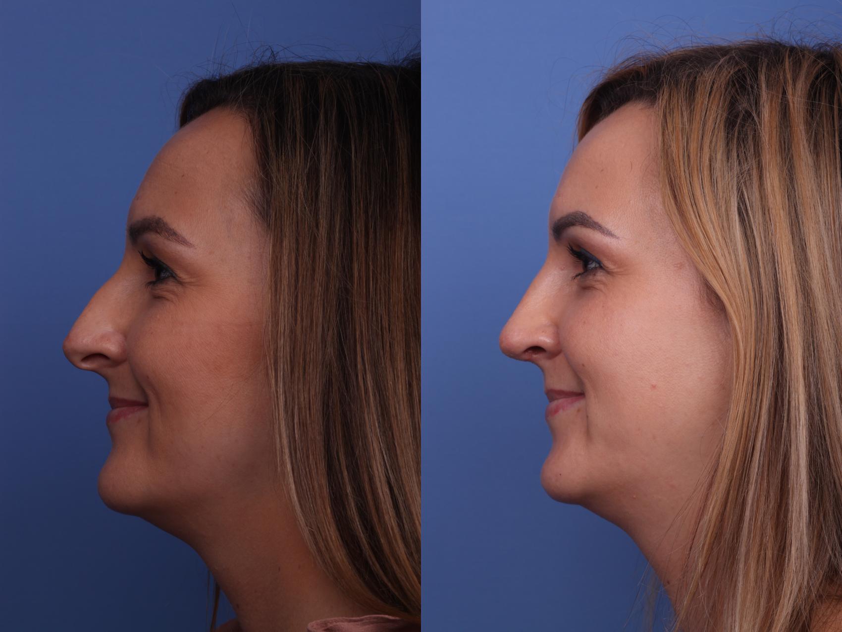 Before & After Rhinoplasty Case 256 View #2 View in Scottsdale, AZ