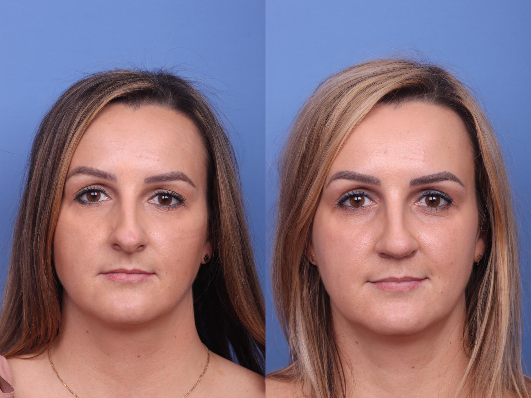 Before & After Rhinoplasty Case 256 View #3 View in Scottsdale, AZ