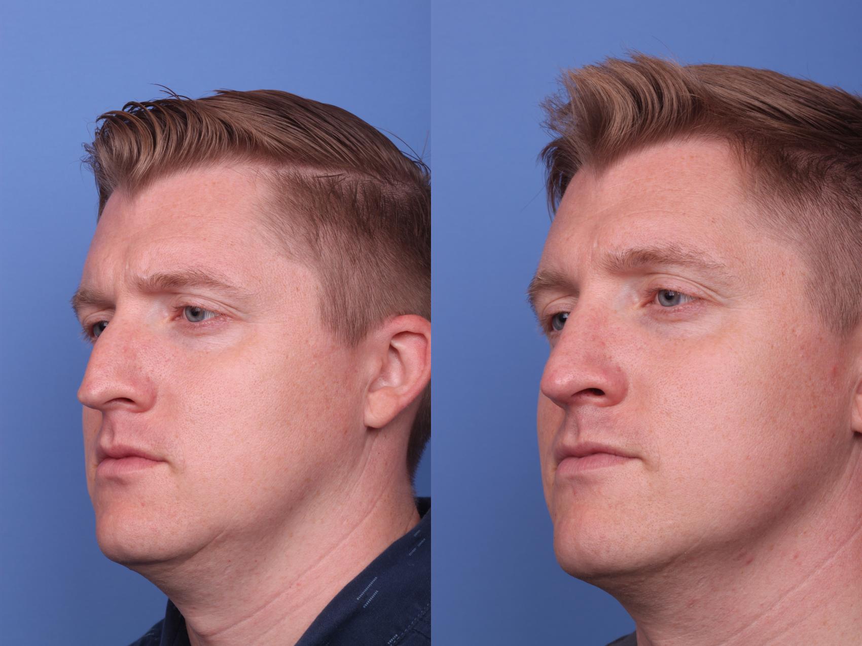 Before & After Rhinoplasty Case 258 View #3 View in Scottsdale, AZ