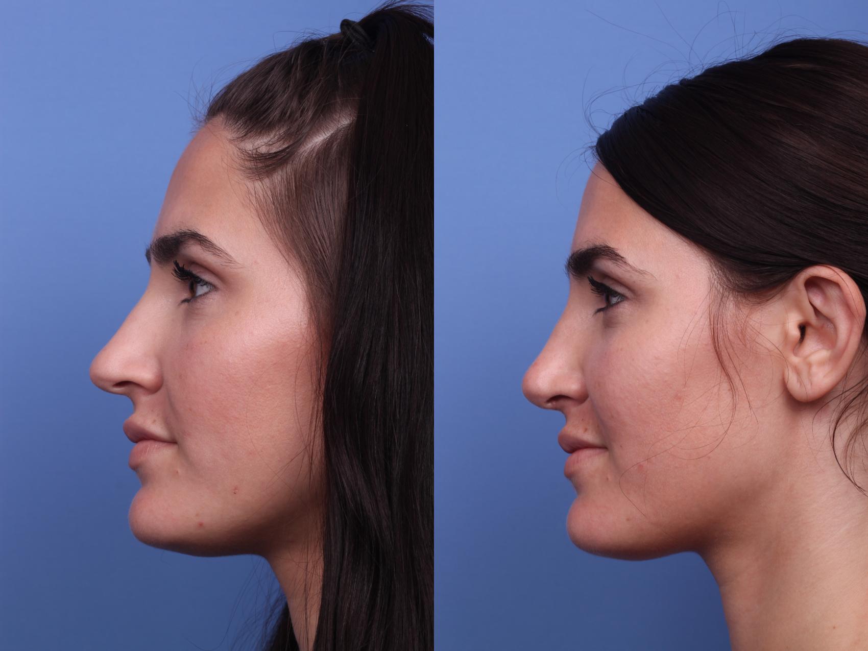 Before & After Rhinoplasty Case 260 View #2 View in Scottsdale, AZ