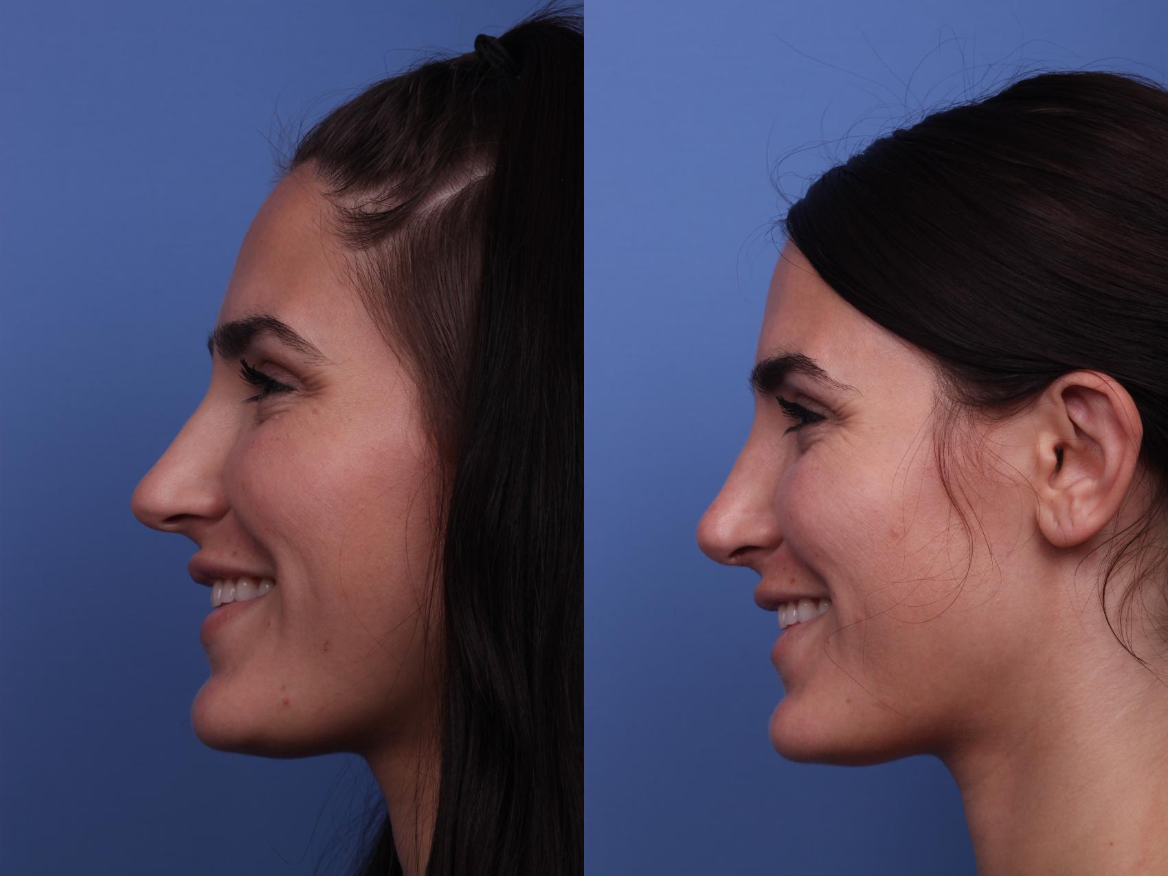Before & After Rhinoplasty Case 260 View #3 View in Scottsdale, AZ