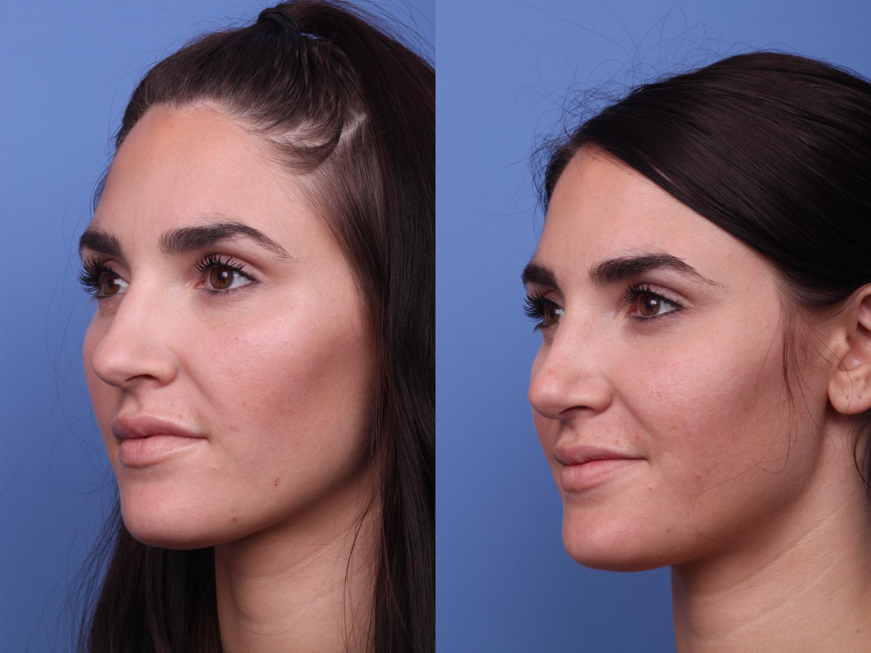 Before & After Rhinoplasty Case 260 View #4 View in Scottsdale, AZ