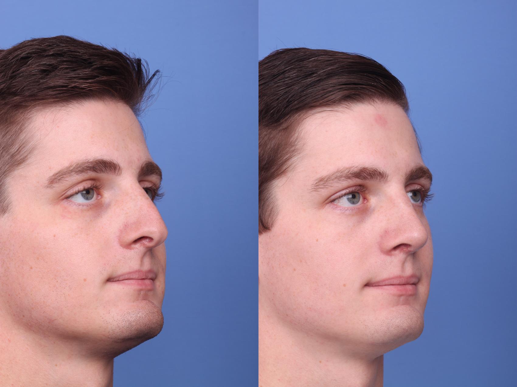 Before & After Rhinoplasty Case 261 View #2 View in Scottsdale, AZ
