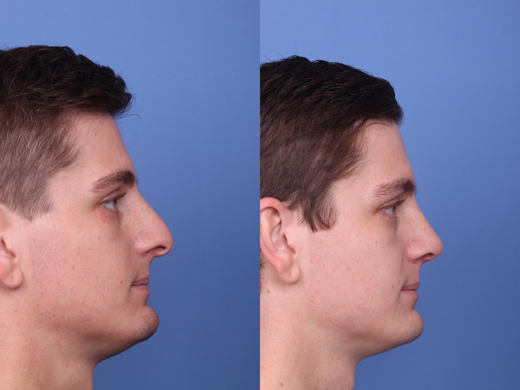 Before & After Rhinoplasty Case 261 View #3 View in Scottsdale, AZ