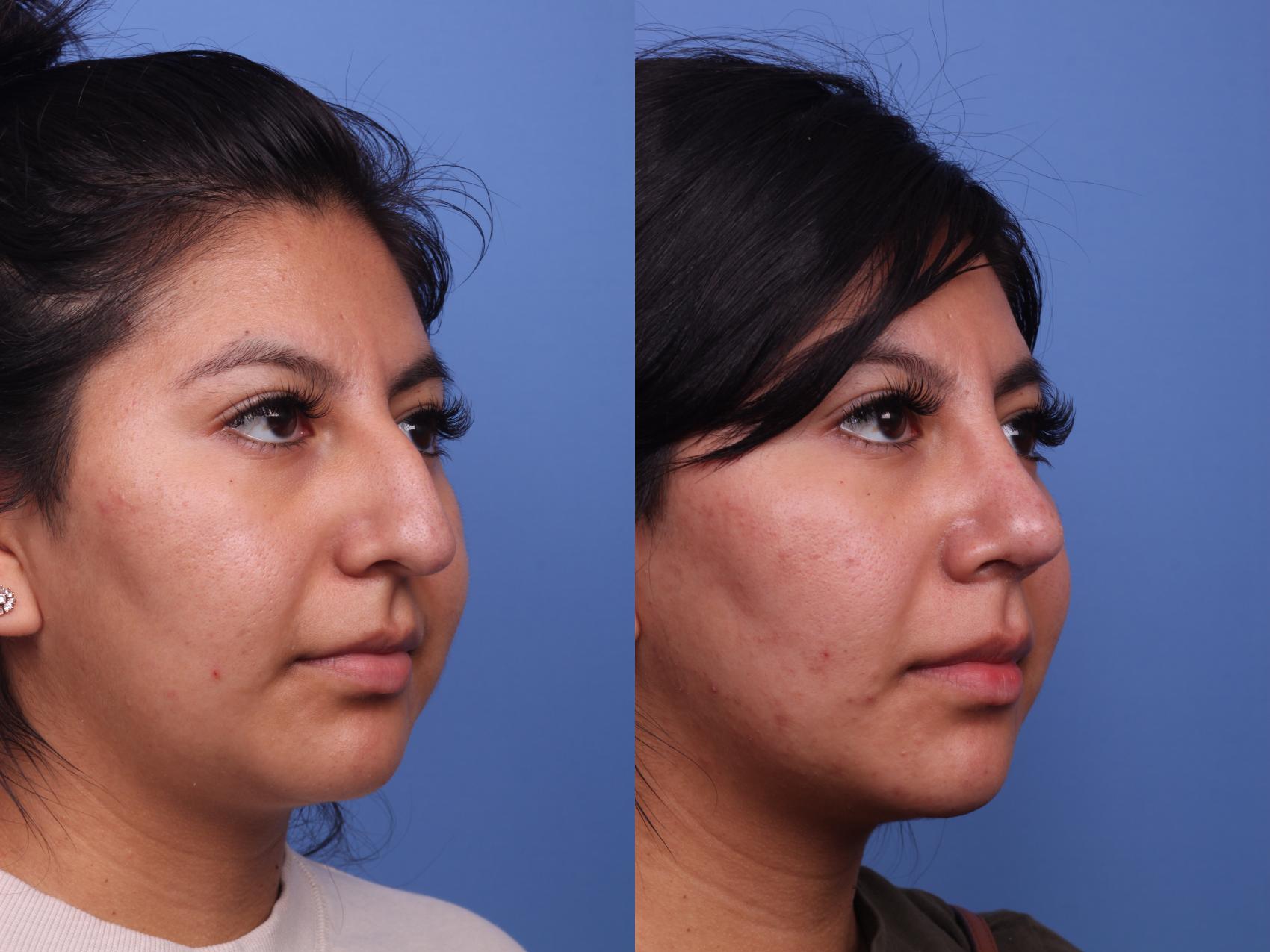 Before & After Rhinoplasty Case 266 View #2 View in Scottsdale, AZ