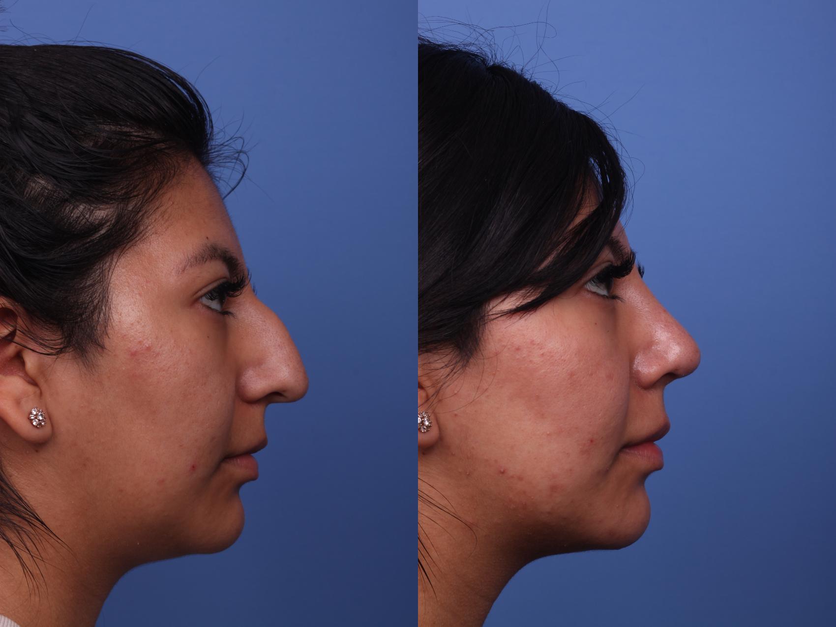 Before & After Rhinoplasty Case 266 View #3 View in Scottsdale, AZ