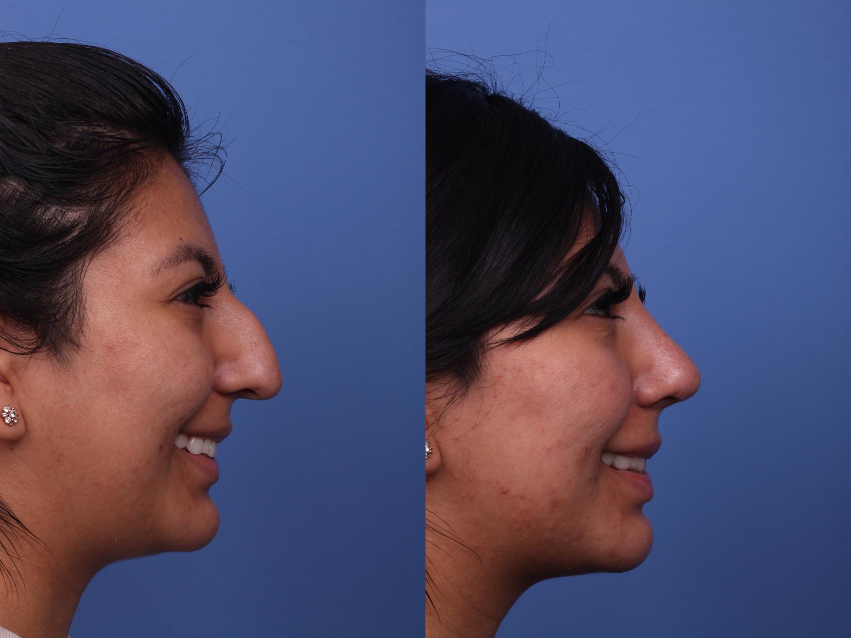 Before & After Rhinoplasty Case 266 View #4 View in Scottsdale, AZ