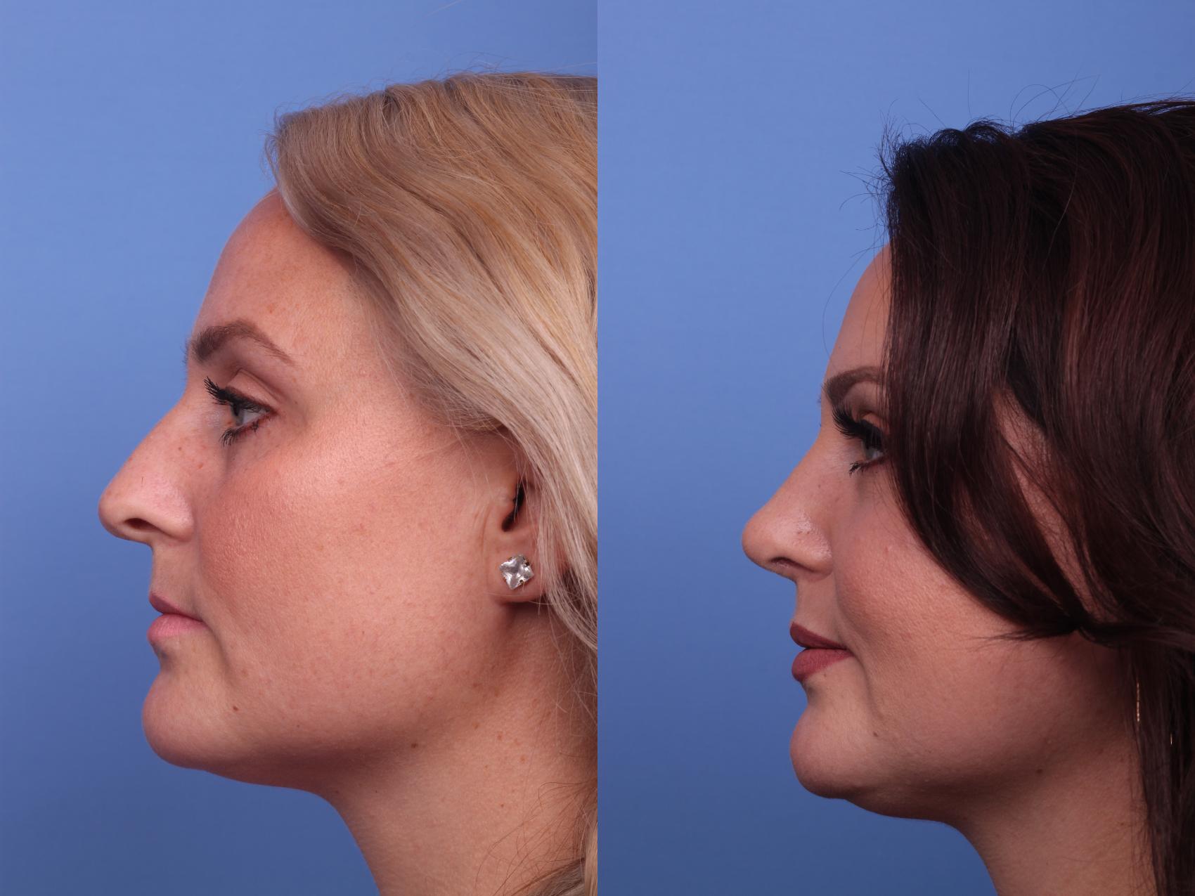 Before & After Rhinoplasty Case 269 View #2 View in Scottsdale, AZ