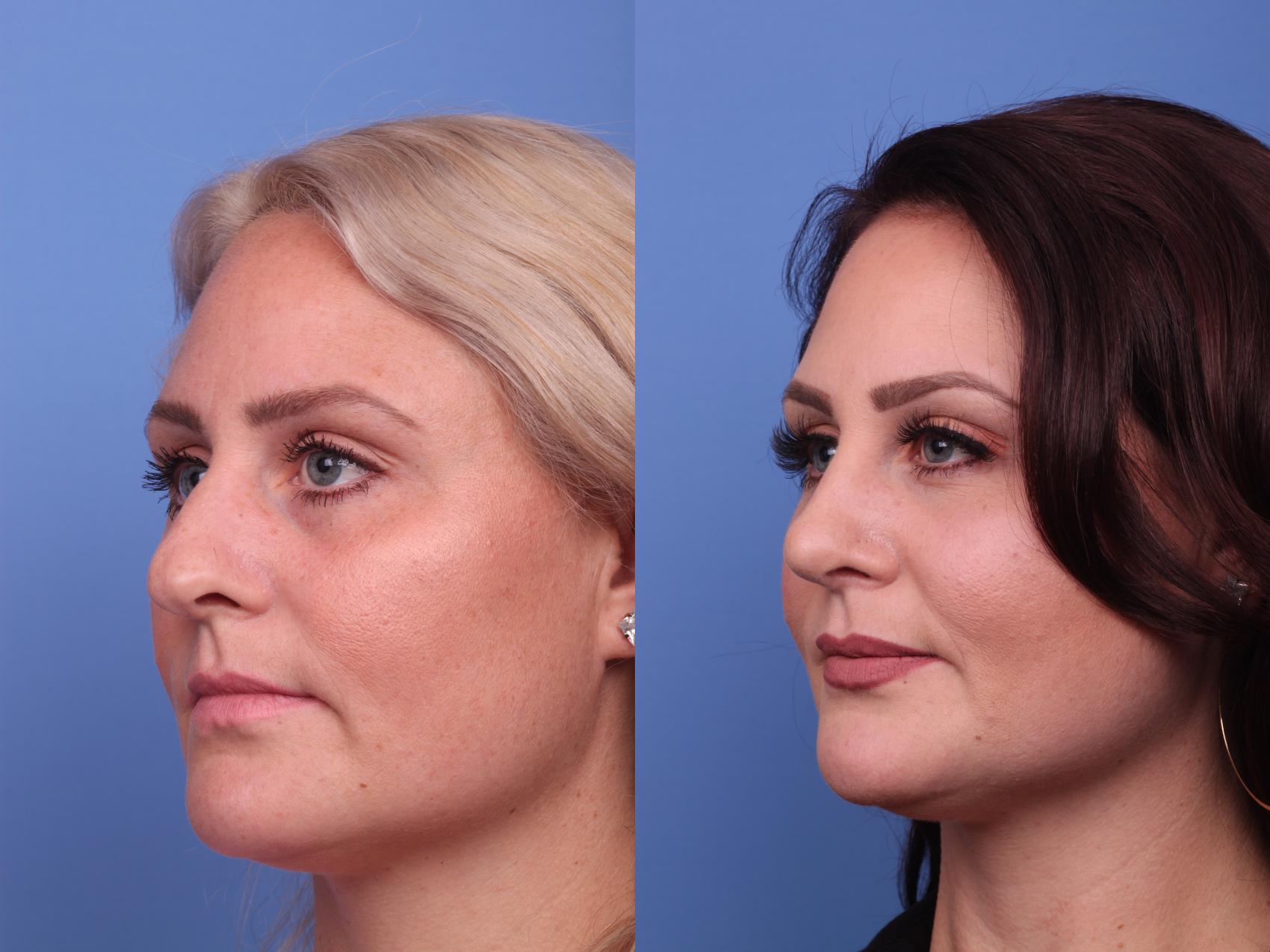 Before & After Rhinoplasty Case 269 View #3 View in Scottsdale, AZ