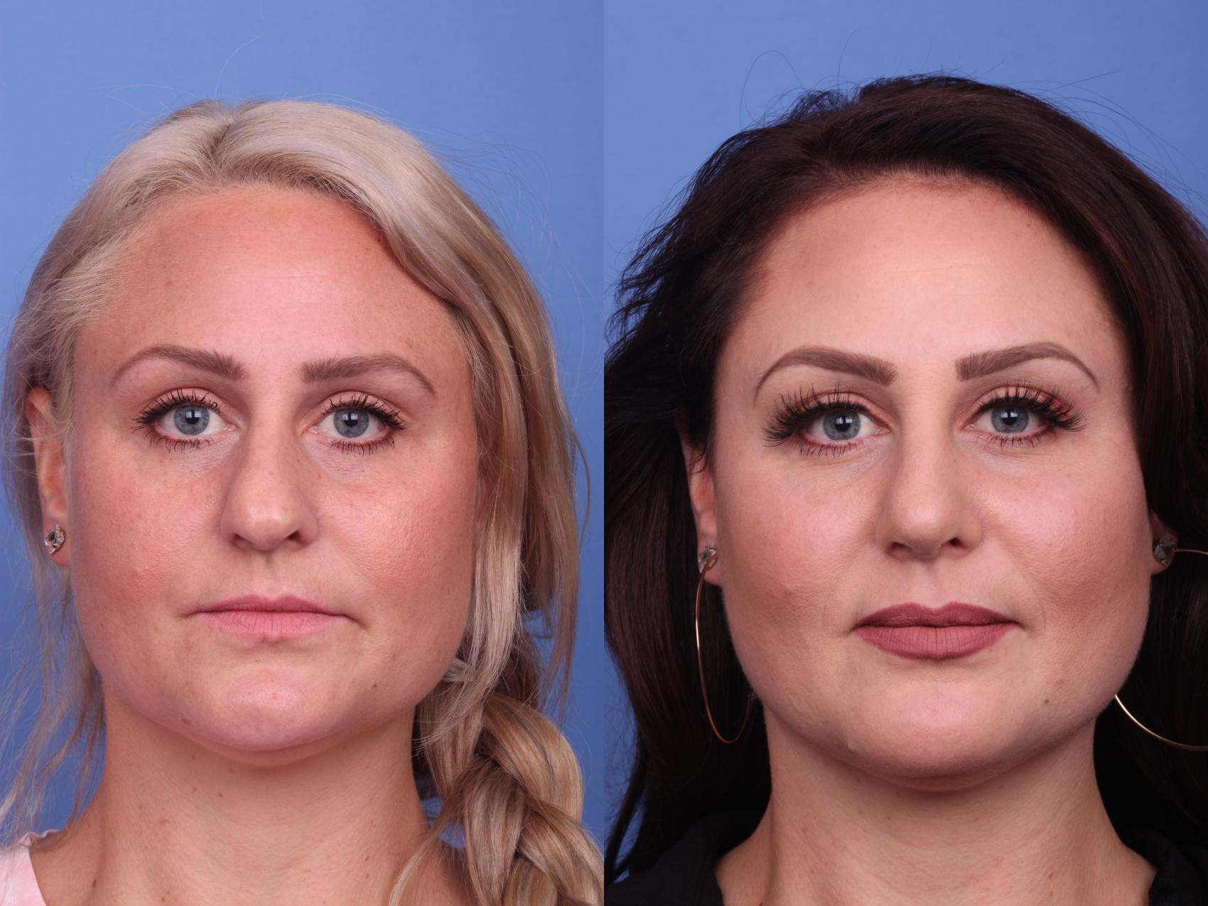 Before & After Rhinoplasty Case 269 View #4 View in Scottsdale, AZ