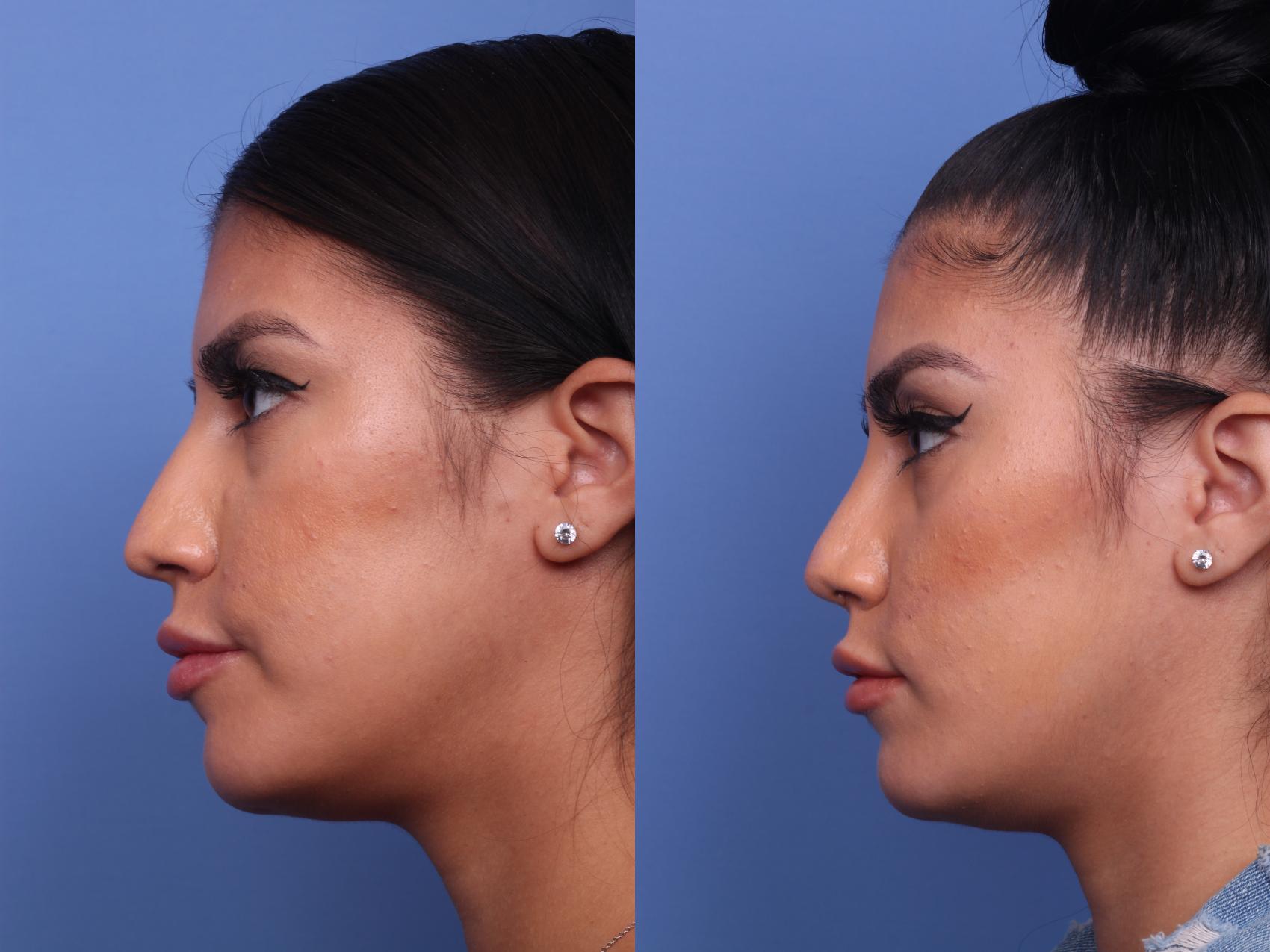Before & After Ethnic Rhinoplasty Case 271 View #2 View in Scottsdale, AZ