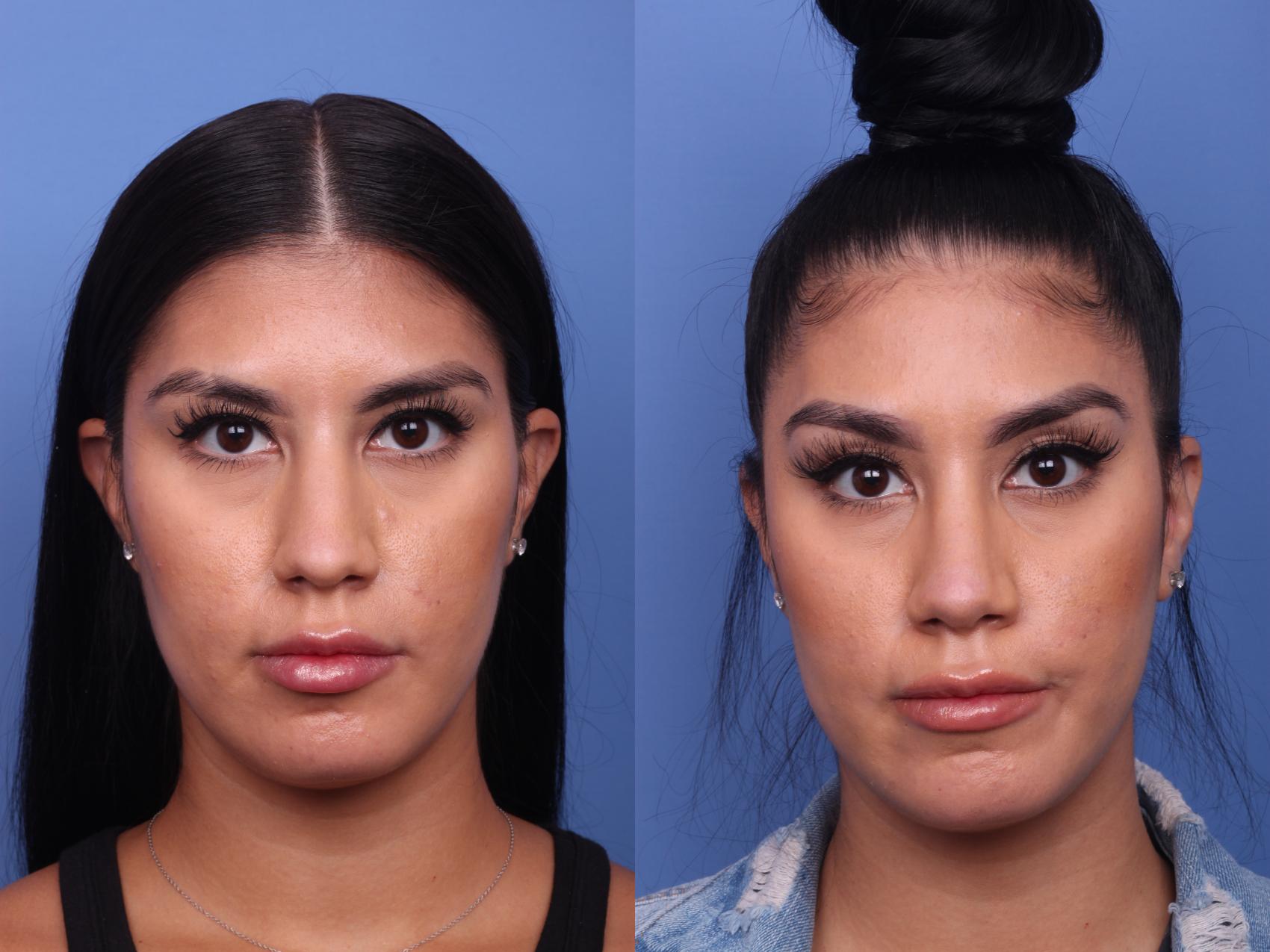 Before & After Ethnic Rhinoplasty Case 271 View #3 View in Scottsdale, AZ