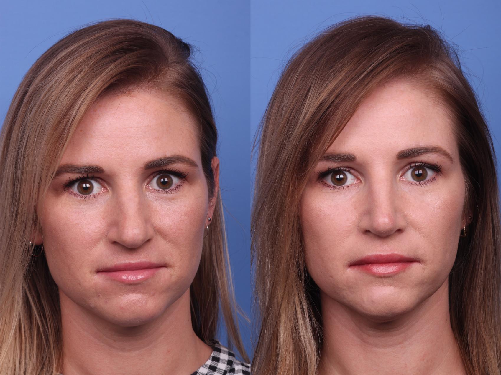 Before & After Rhinoplasty Case 273 View #2 View in Scottsdale, AZ