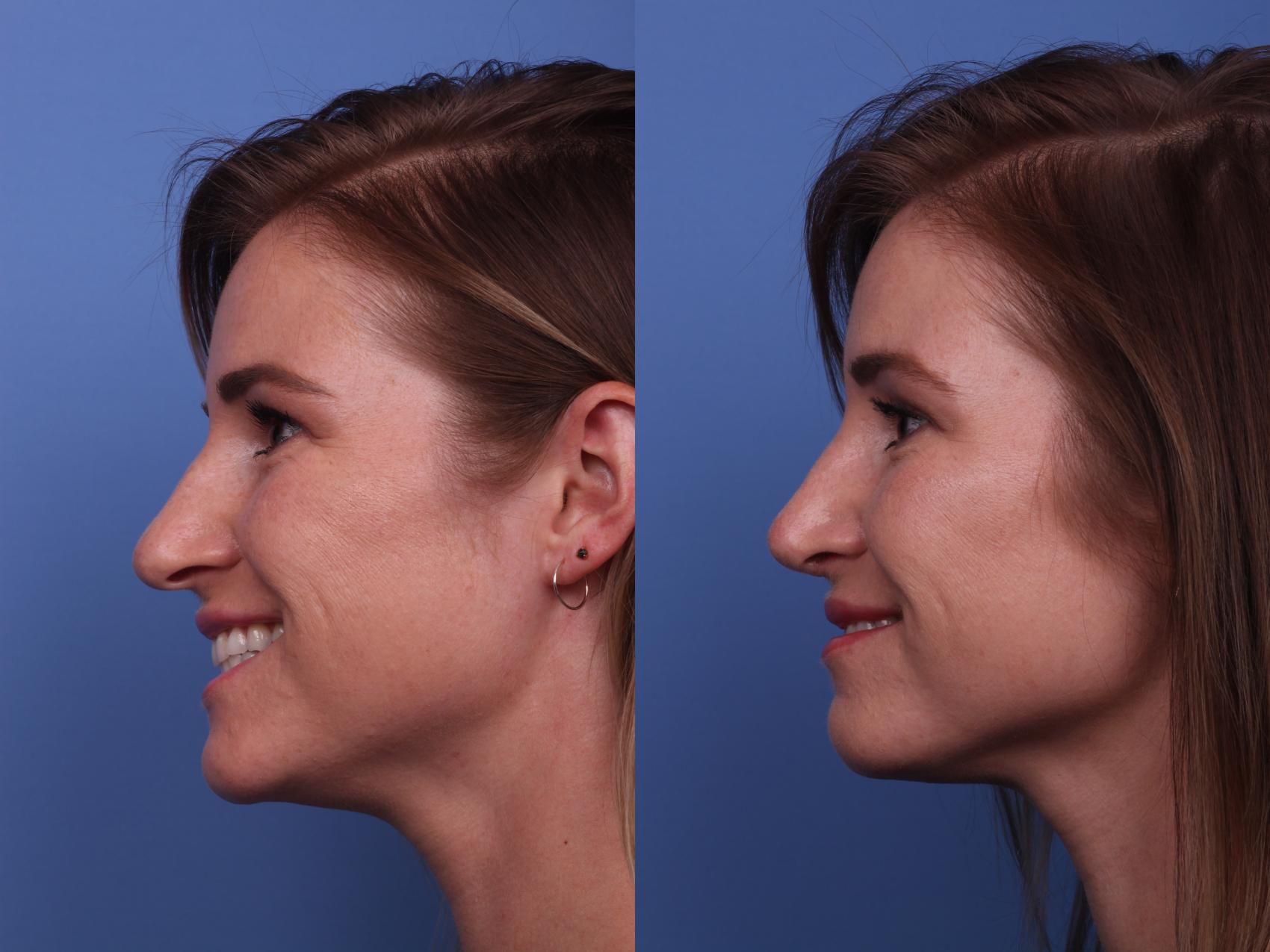 Before & After Rhinoplasty Case 273 View #3 View in Scottsdale, AZ