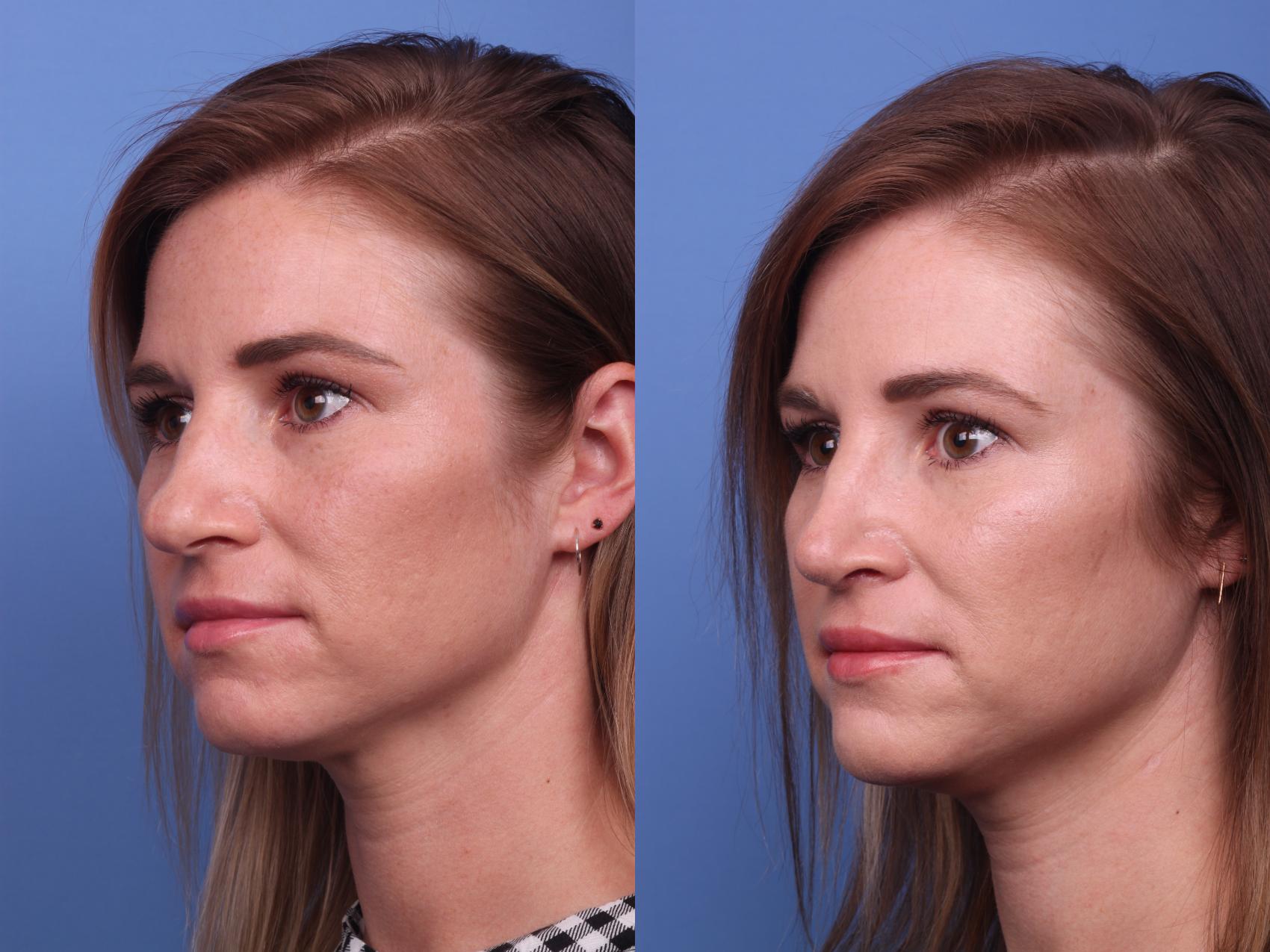 Before & After Rhinoplasty Case 273 View #4 View in Scottsdale, AZ