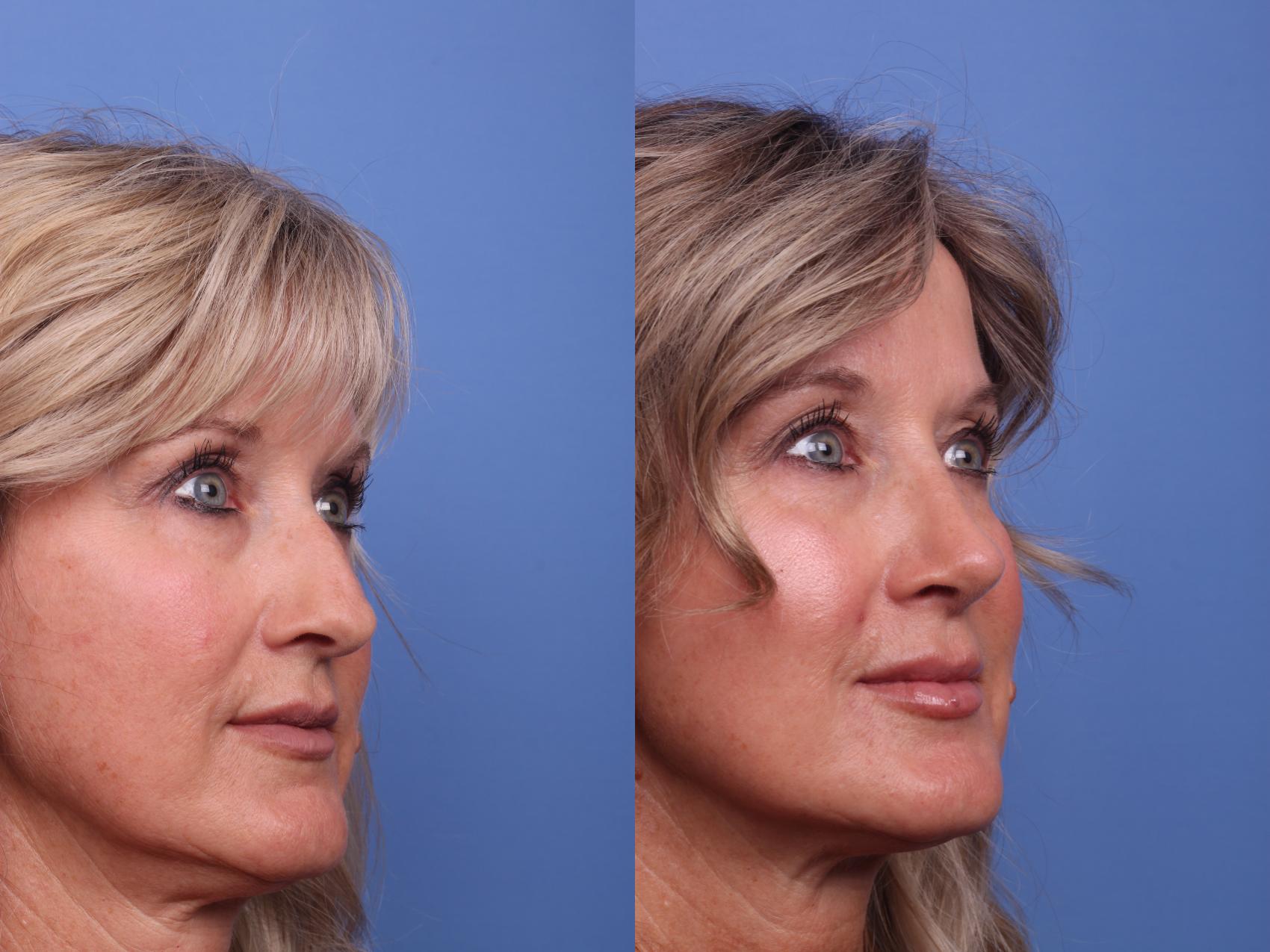 Before & After Rhinoplasty Case 274 View #2 View in Scottsdale, AZ