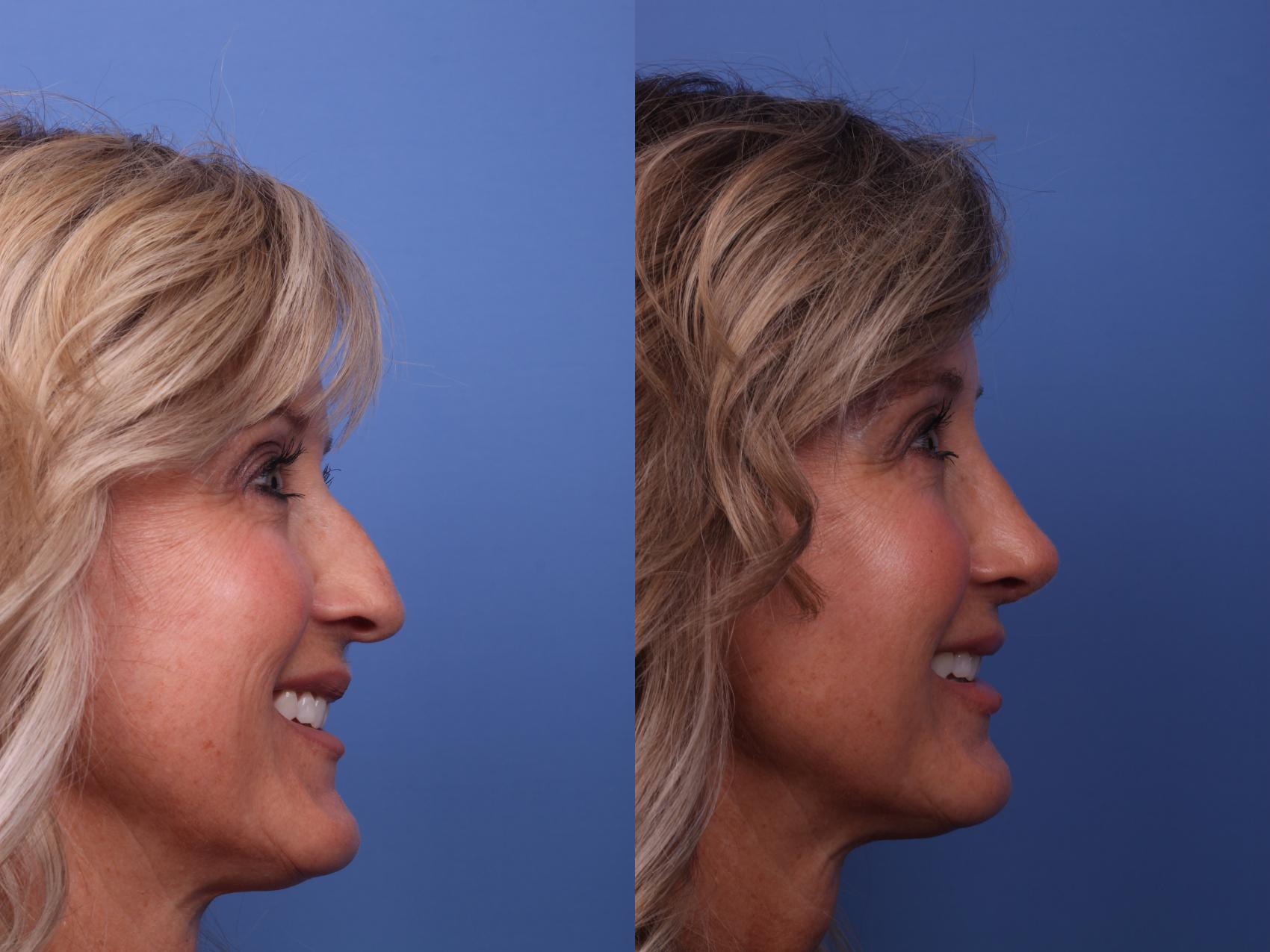 Before & After Rhinoplasty Case 274 View #3 View in Scottsdale, AZ