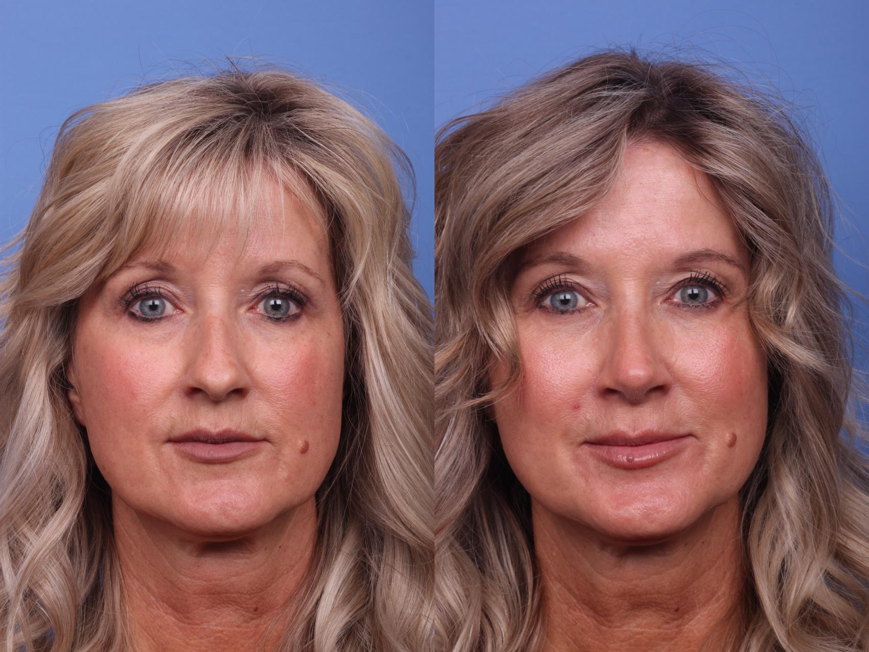 Before & After Rhinoplasty Case 274 View #4 View in Scottsdale, AZ