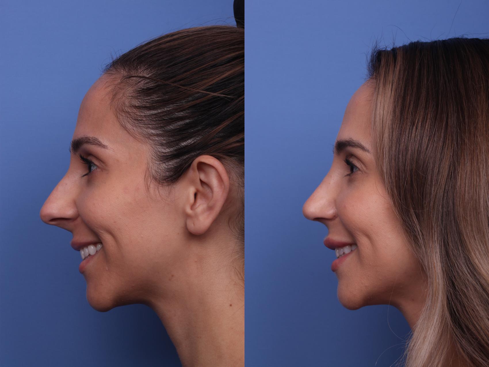 Before & After Rhinoplasty Case 276 View #3 View in Scottsdale, AZ