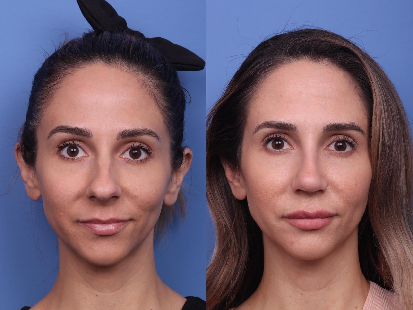 Before & After Rhinoplasty Case 276 View #4 View in Scottsdale, AZ