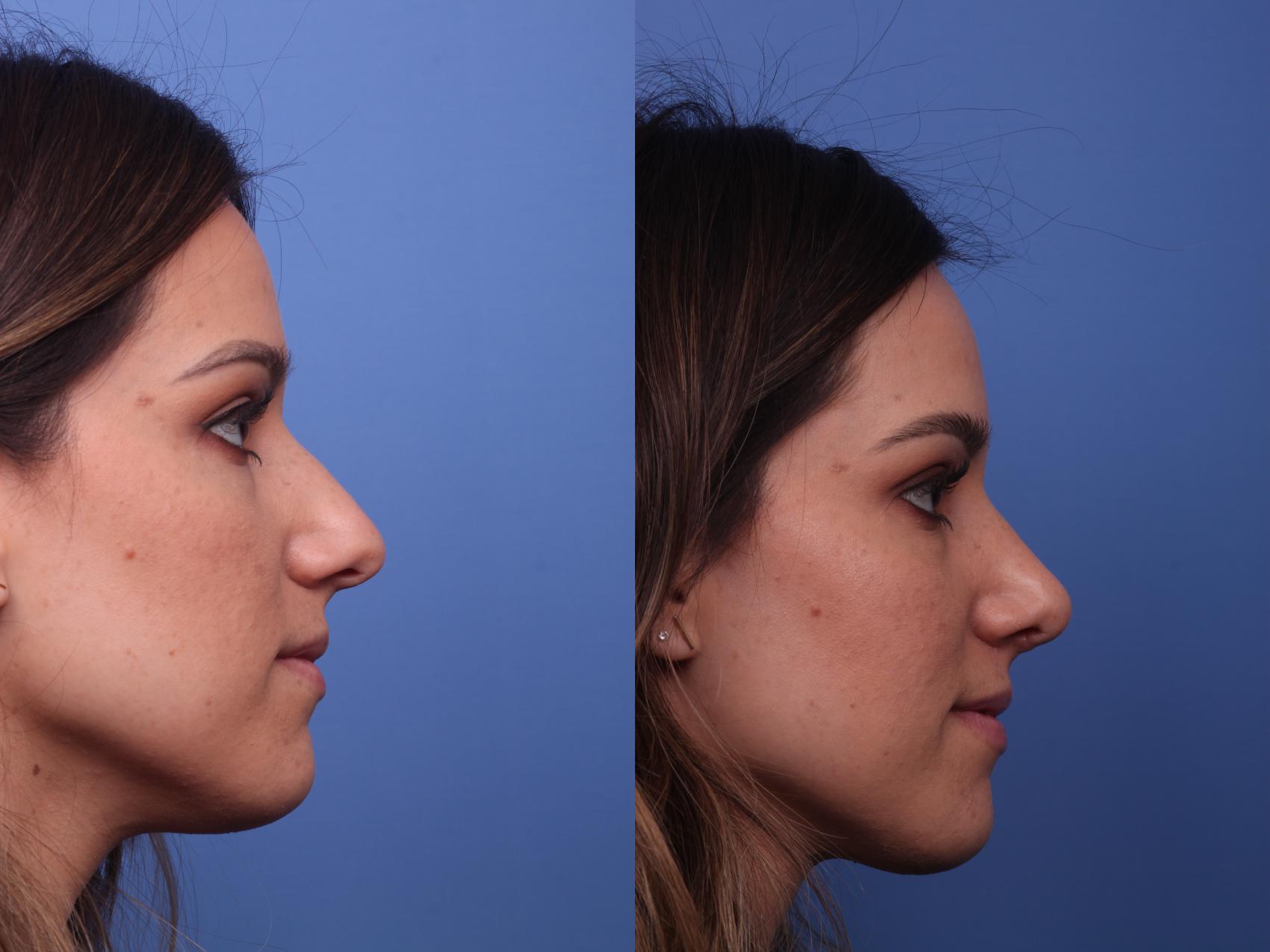 Before & After Rhinoplasty Case 278 View #2 View in Scottsdale, AZ