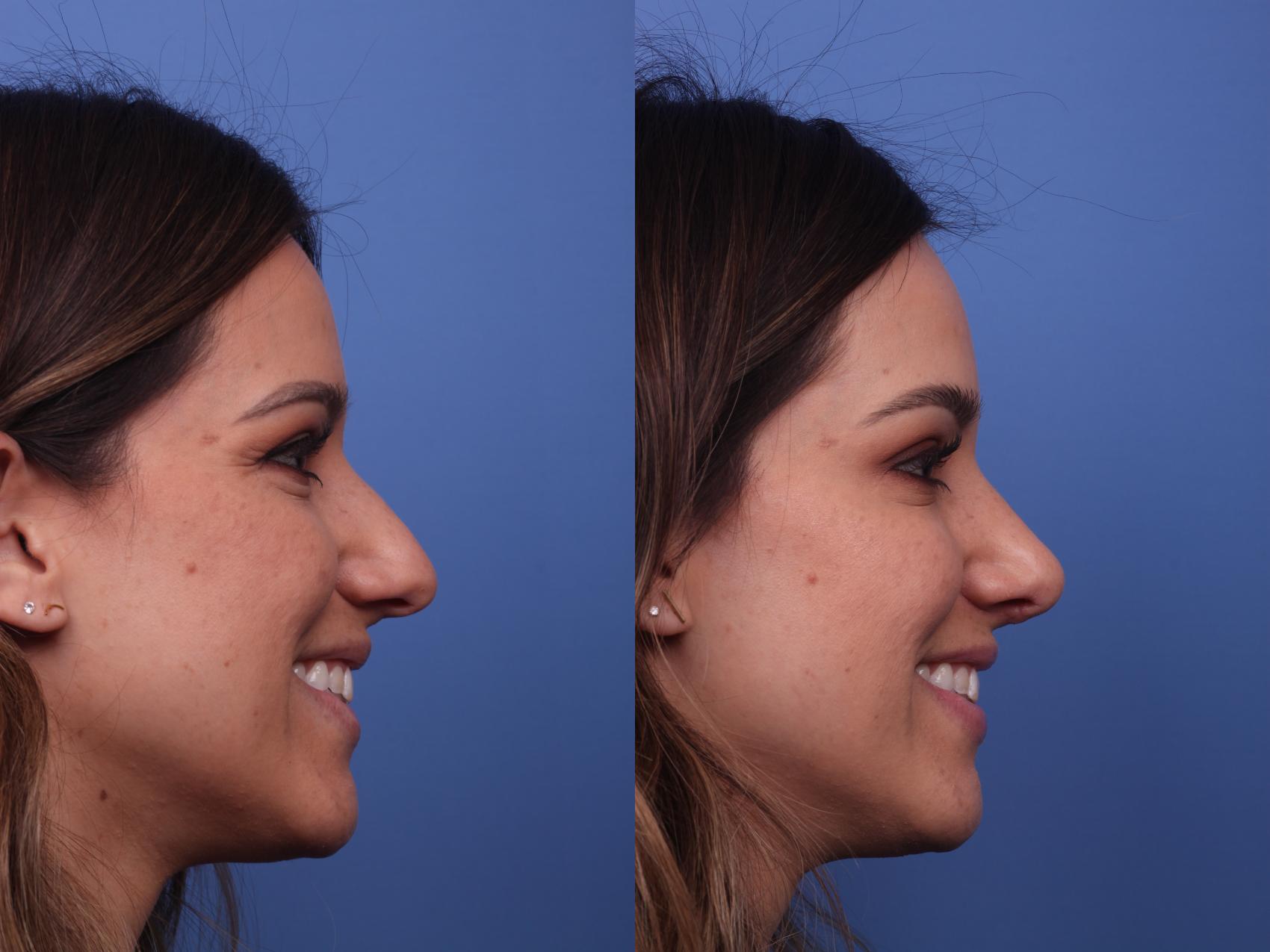 Before & After Rhinoplasty Case 278 View #3 View in Scottsdale, AZ