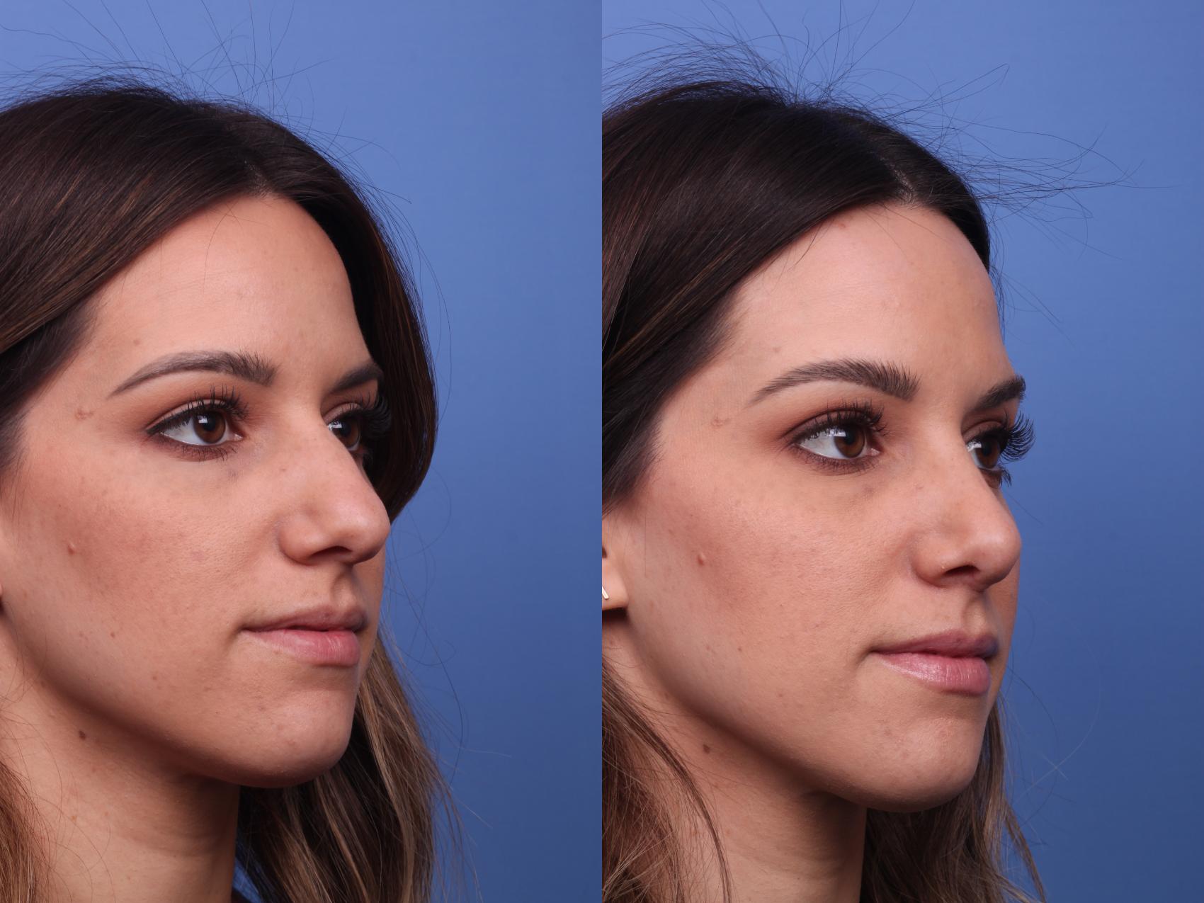 Before & After Rhinoplasty Case 278 View #4 View in Scottsdale, AZ