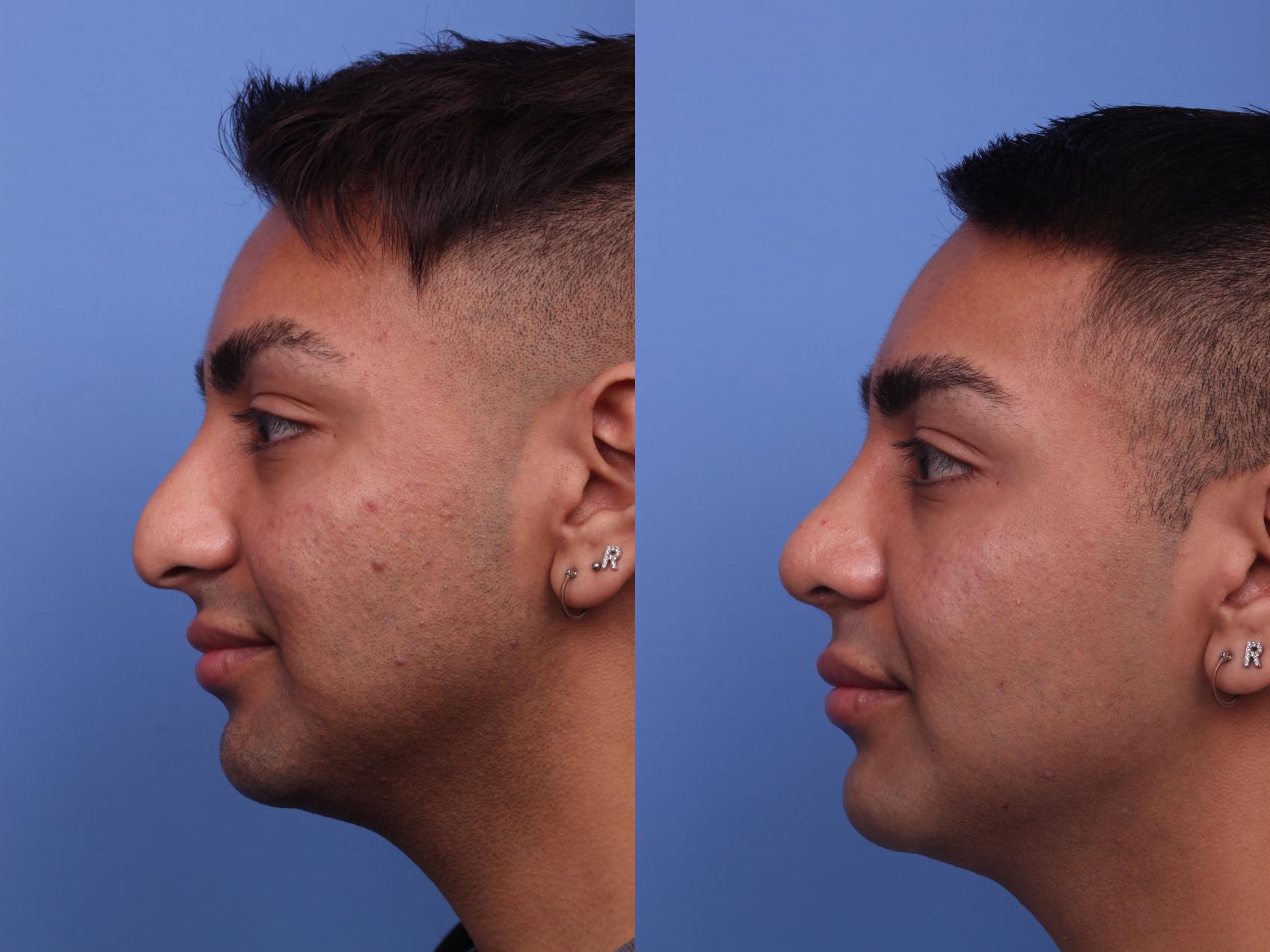 Before & After Rhinoplasty Case 280 View #2 View in Scottsdale, AZ