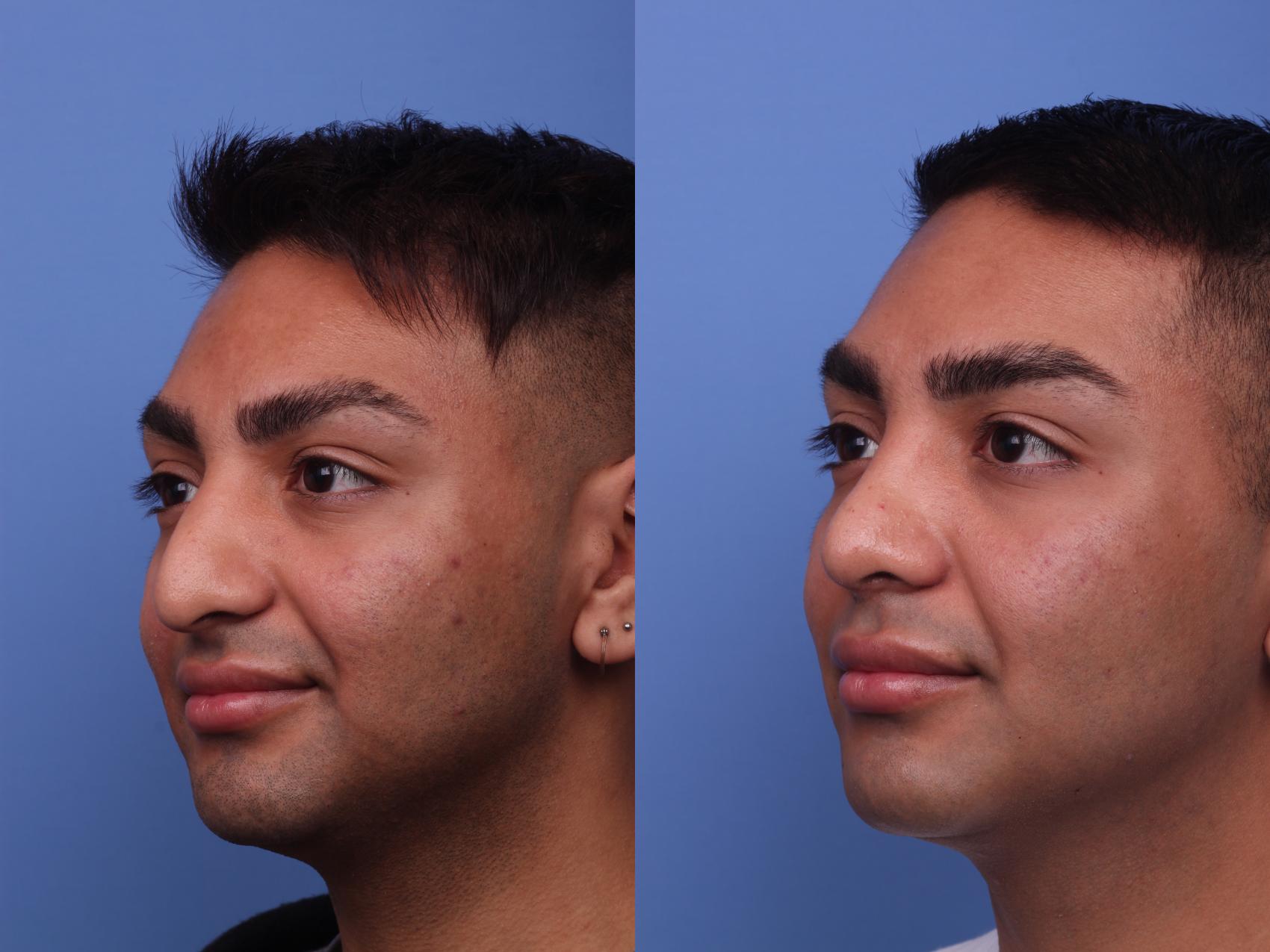 Before & After Rhinoplasty Case 280 View #3 View in Scottsdale, AZ