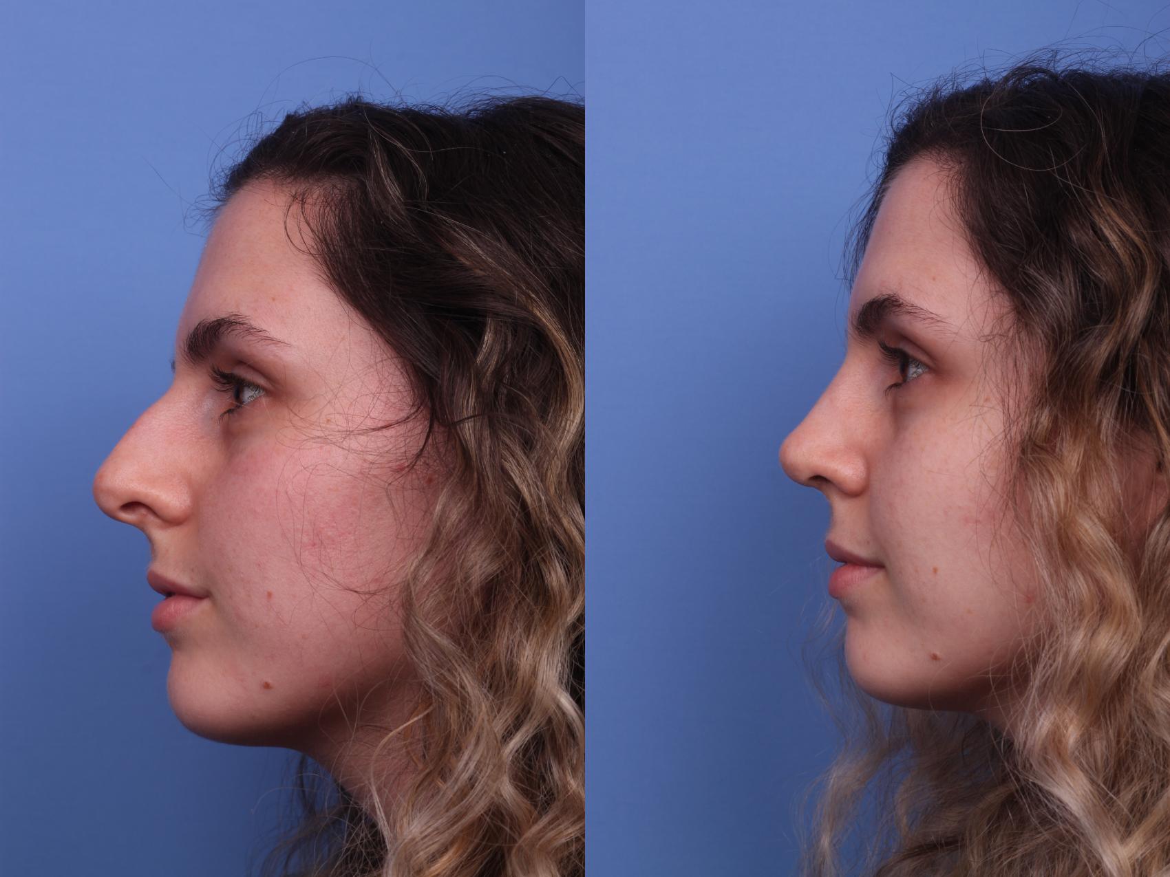 Before & After Rhinoplasty Case 281 View #2 View in Scottsdale, AZ