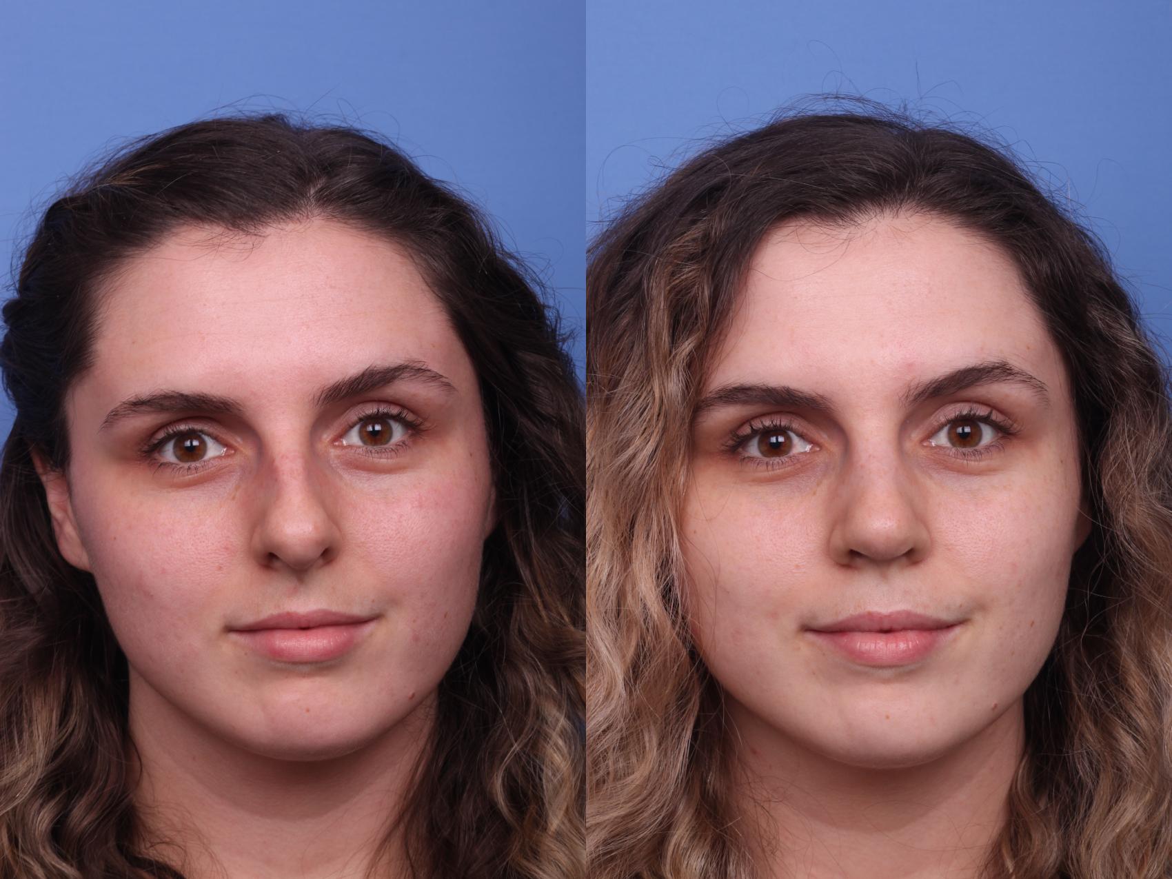 Before & After Rhinoplasty Case 281 View #3 View in Scottsdale, AZ