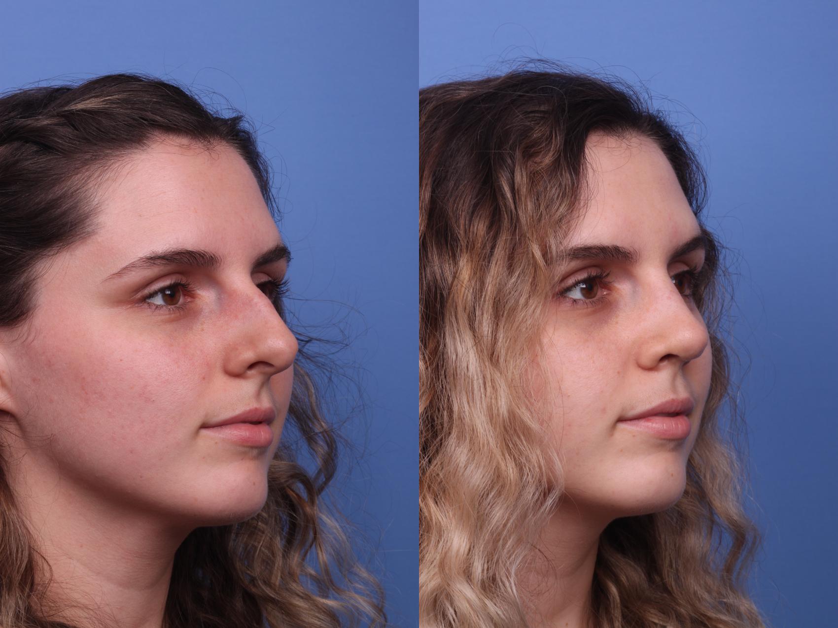 Before & After Rhinoplasty Case 281 View #4 View in Scottsdale, AZ