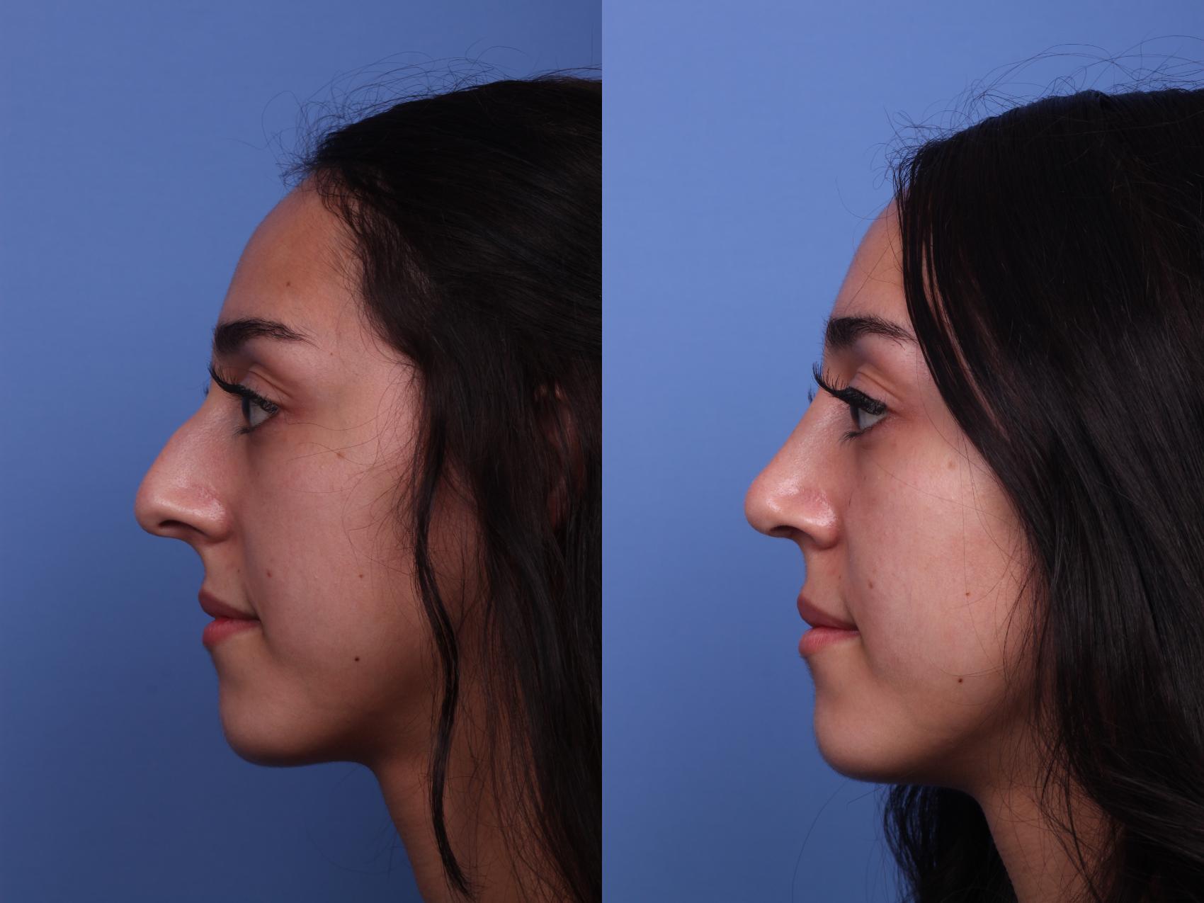 Before & After Rhinoplasty Case 283 View #2 View in Scottsdale, AZ