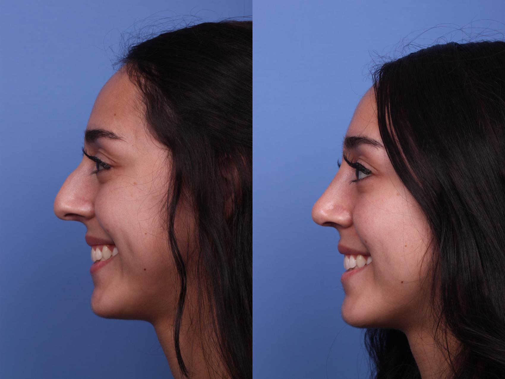 Before & After Rhinoplasty Case 283 View #3 View in Scottsdale, AZ