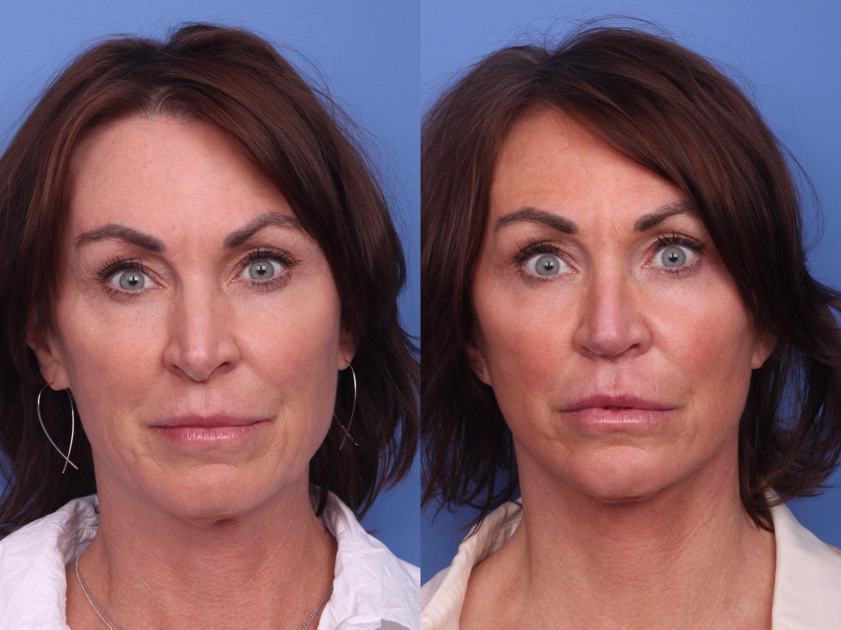 Rhinoplasty Before & After Photo | Scottsdale & Phoenix, AZ | Hobgood Facial Plastic Surgery: Todd Hobgood, MD