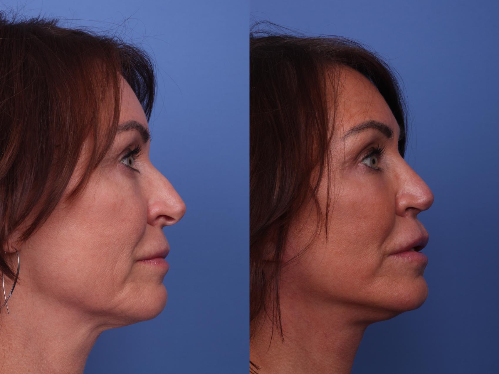 Before & After Rhinoplasty Case 284 View #2 View in Scottsdale, AZ