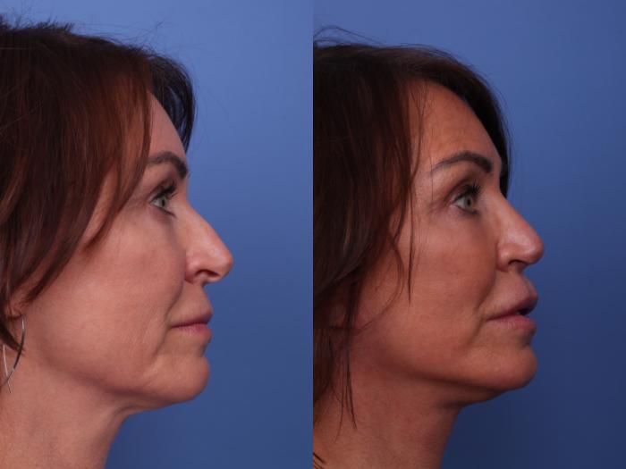 Rhinoplasty Before & After Photo | Scottsdale & Phoenix, AZ | Hobgood Facial Plastic Surgery: Todd Hobgood, MD