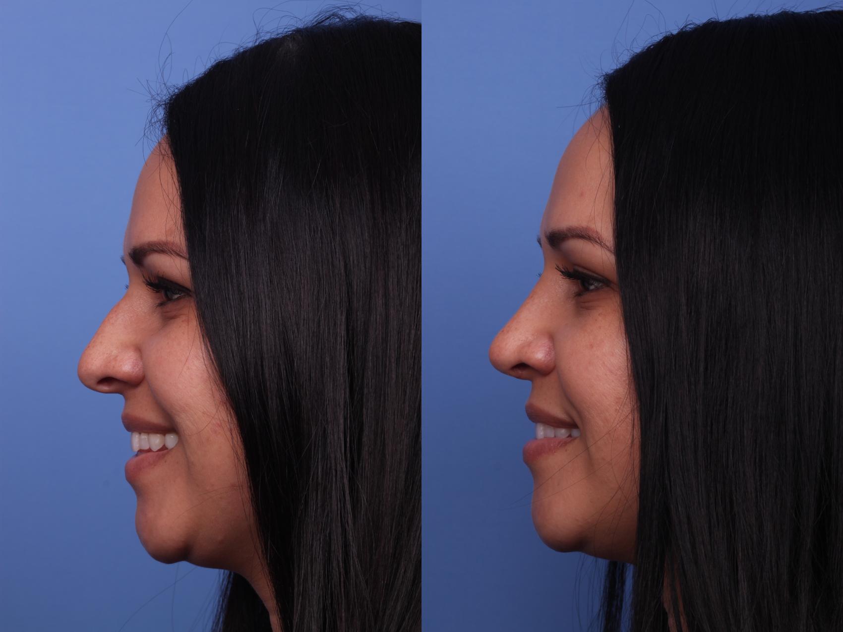 Before & After Rhinoplasty Case 286 View #2 View in Scottsdale, AZ